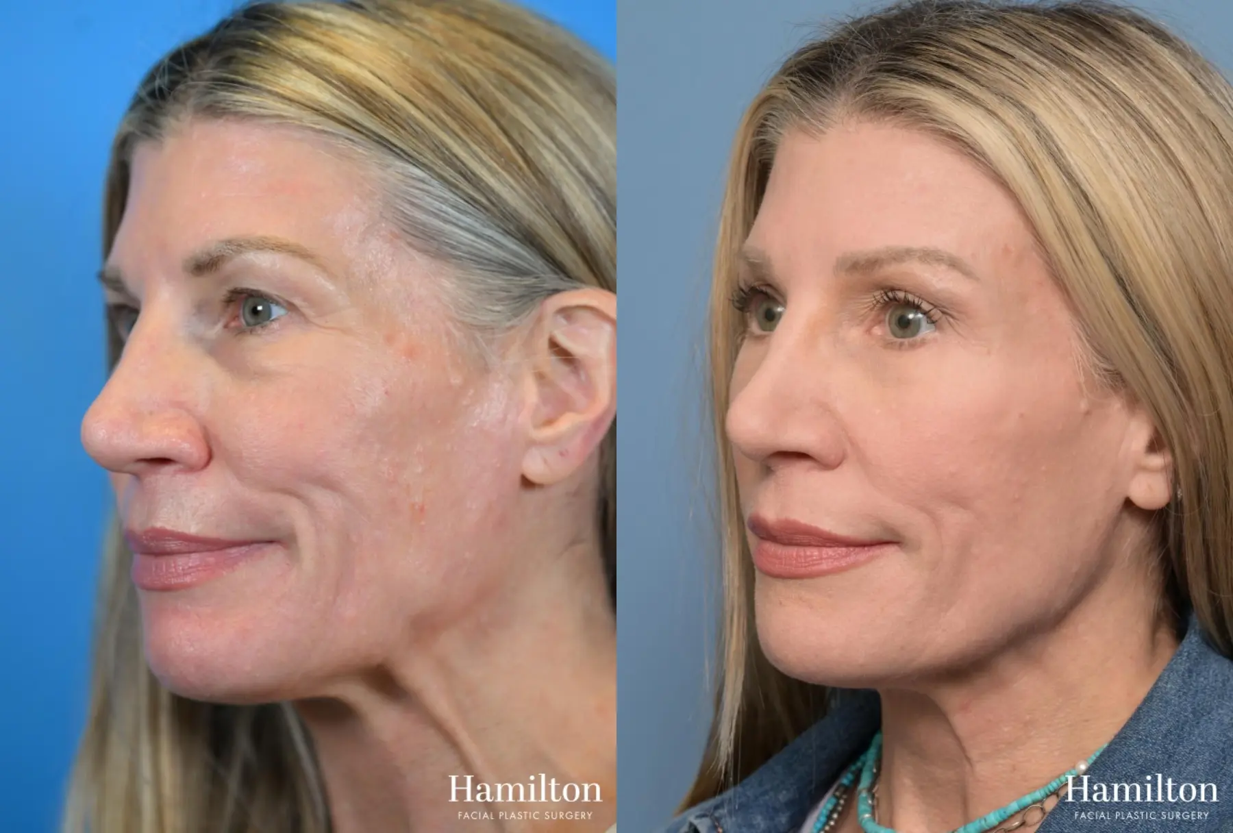 Brow Lift: Patient 6 - Before and After 3
