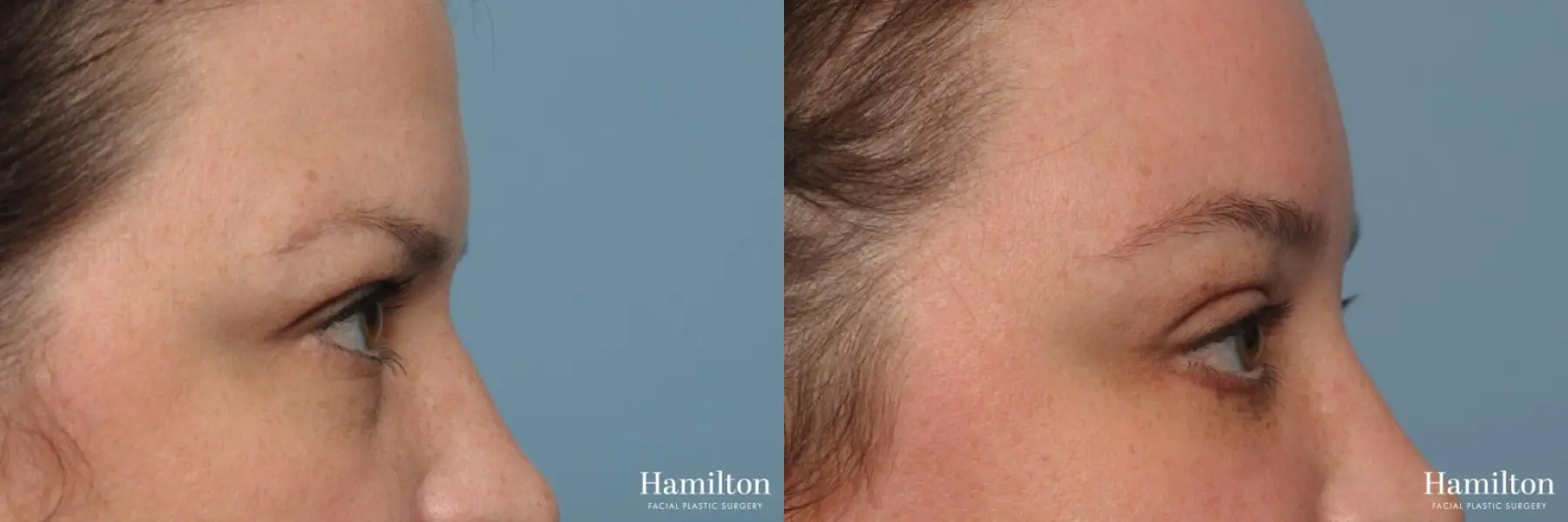 Brow Lift: Patient 1 - Before and After 5