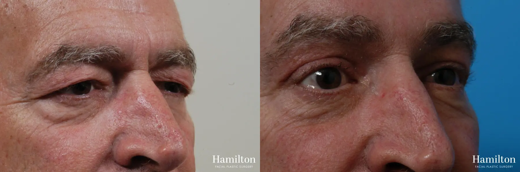 Brow Lift: Patient 8 - Before and After 2