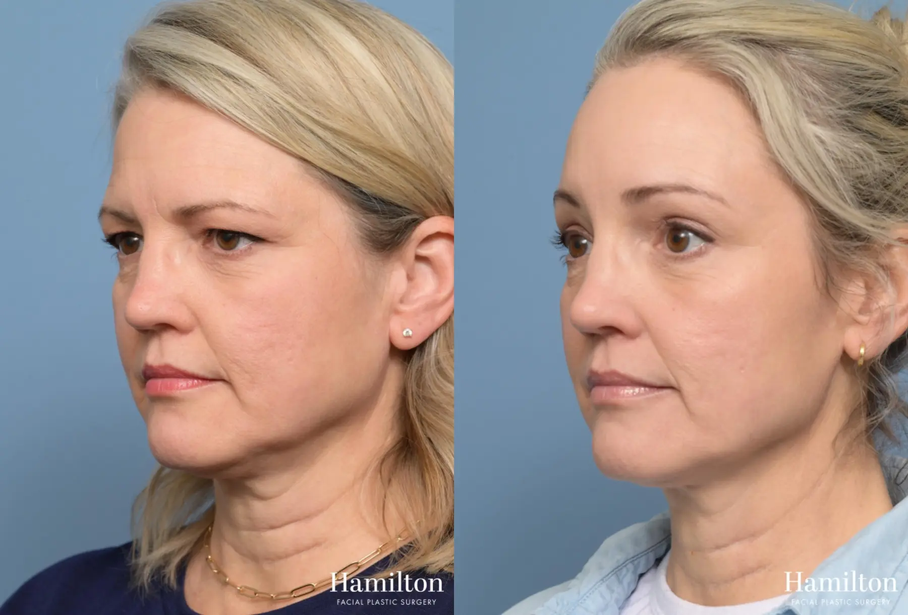 Brow Lift: Patient 3 - Before and After 2
