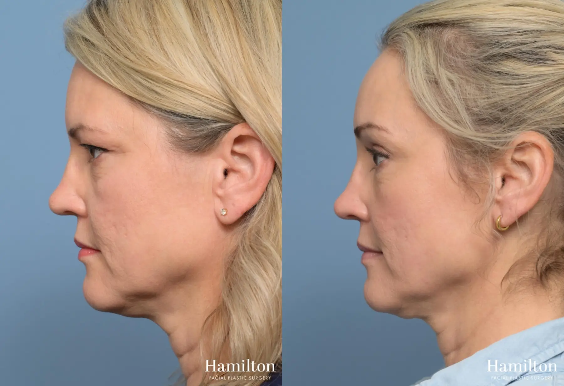 Brow Lift: Patient 3 - Before and After 4