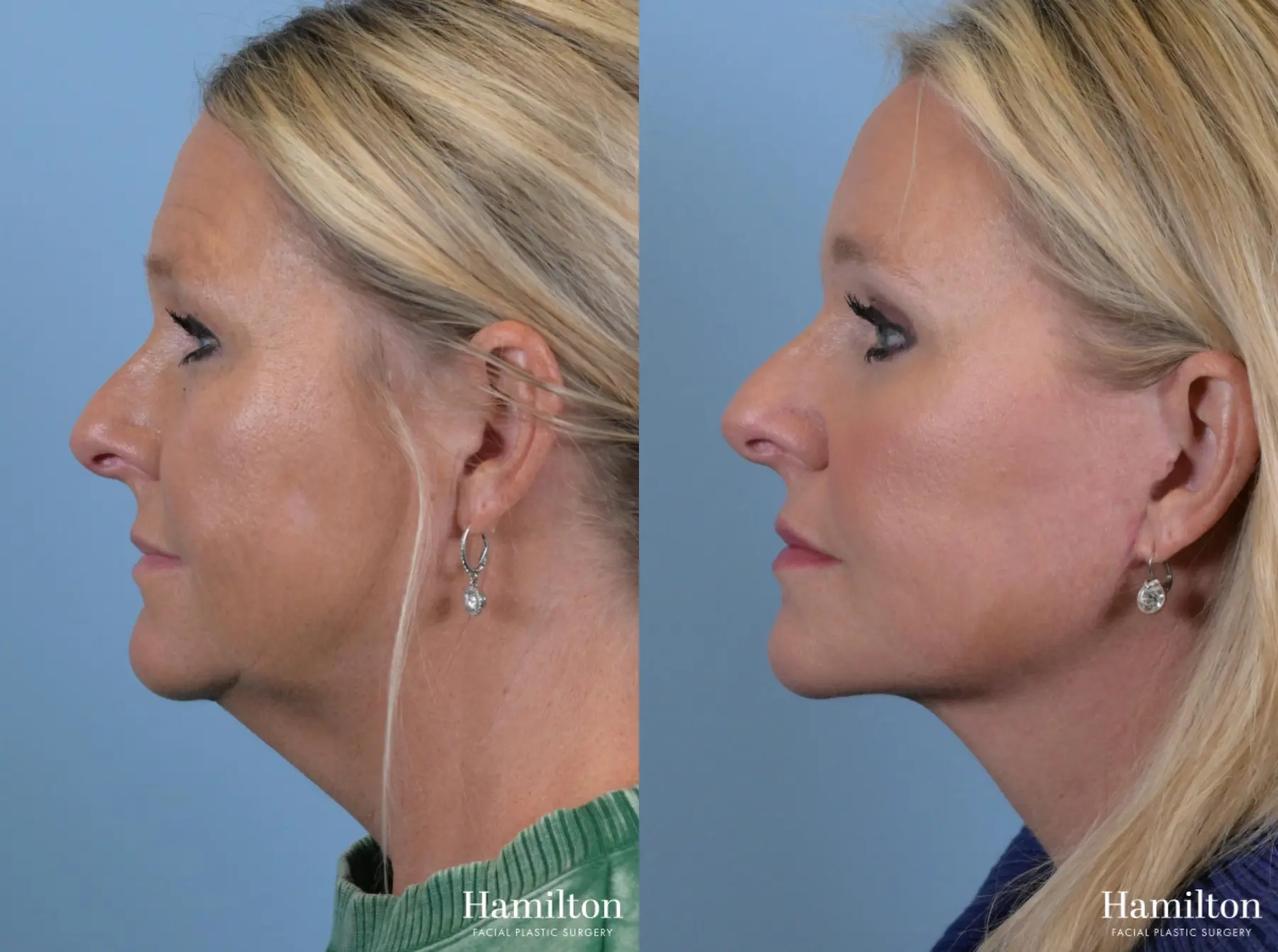 Brow Lift: Patient 6 - Before and After