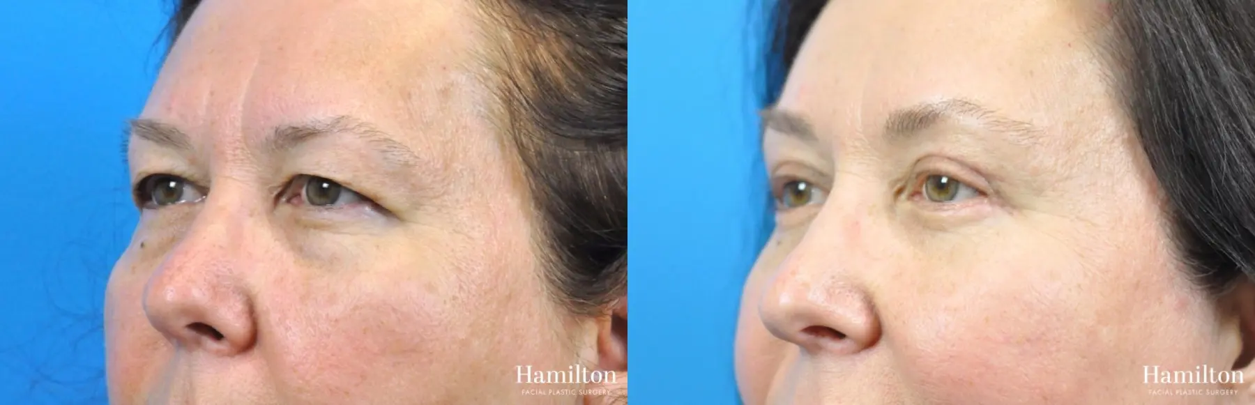 Brow Lift: Patient 9 - Before and After 3