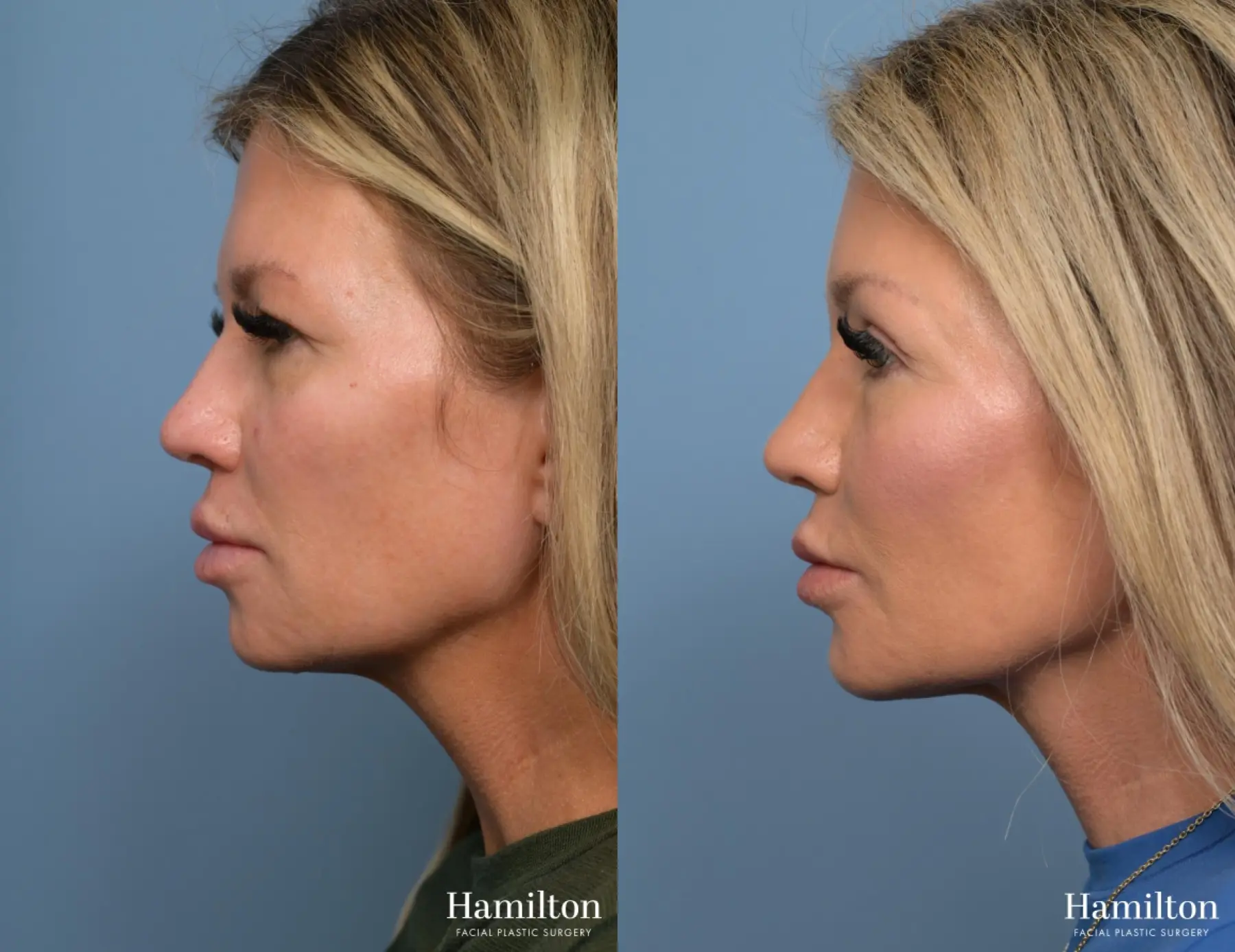 Brow Lift: Patient 2 - Before and After 5