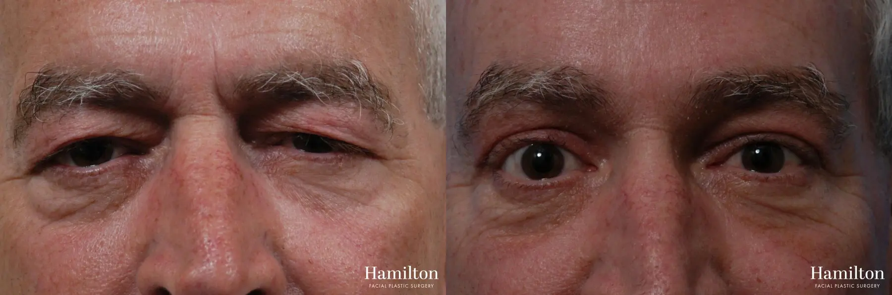 Brow Lift: Patient 8 - Before and After  