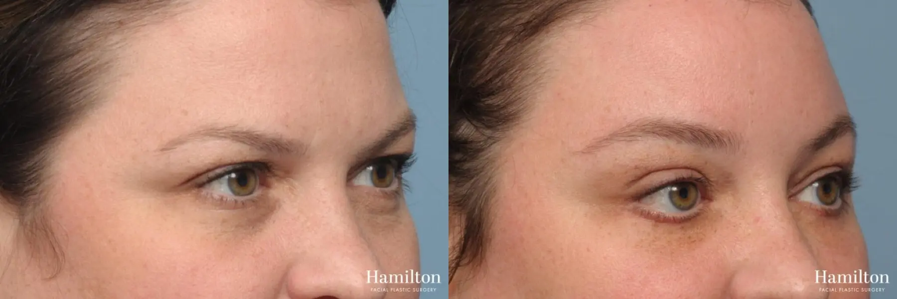 Brow Lift: Patient 1 - Before and After 4