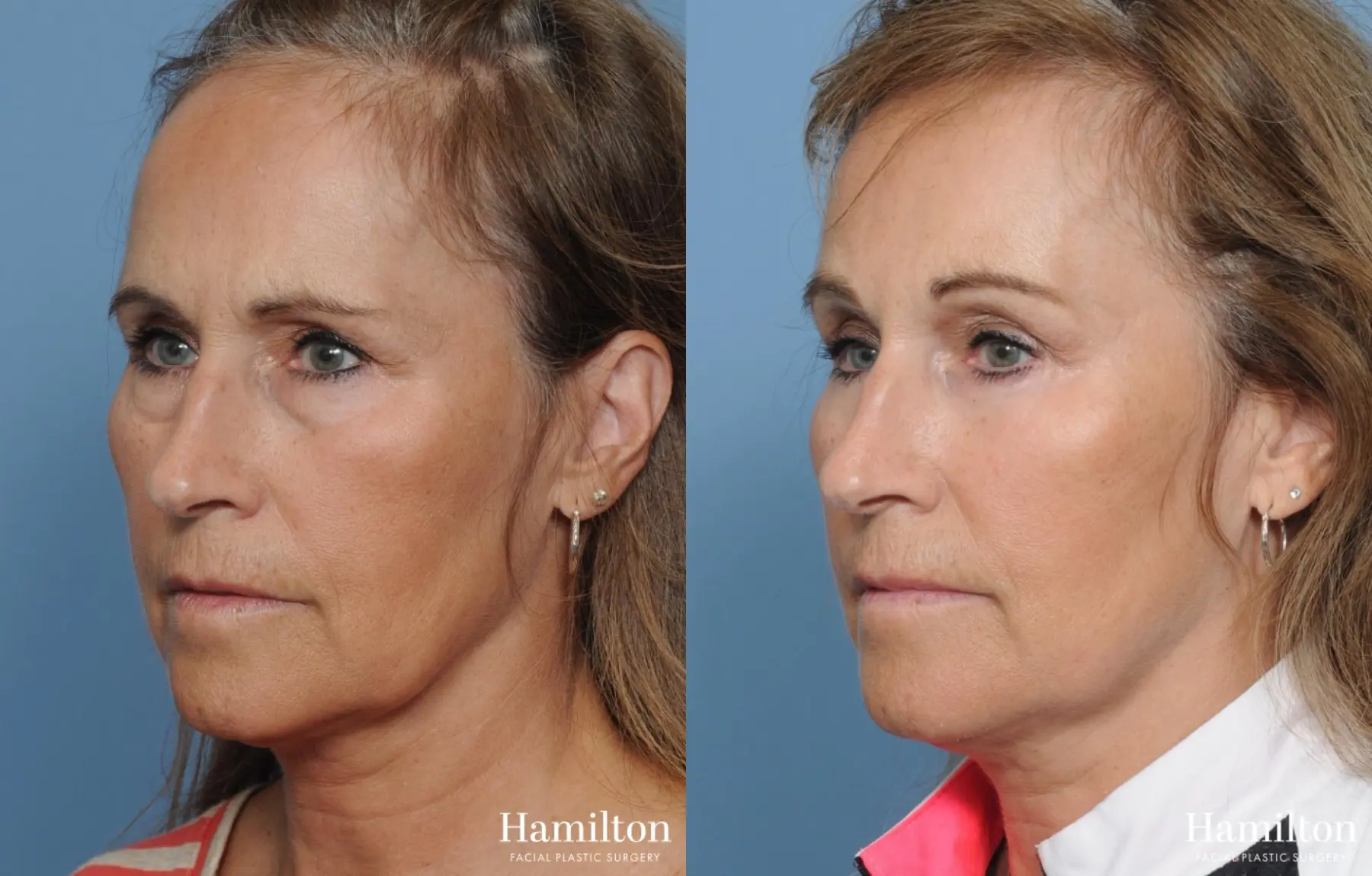 Brow Lift: Patient 10 - Before and After 2