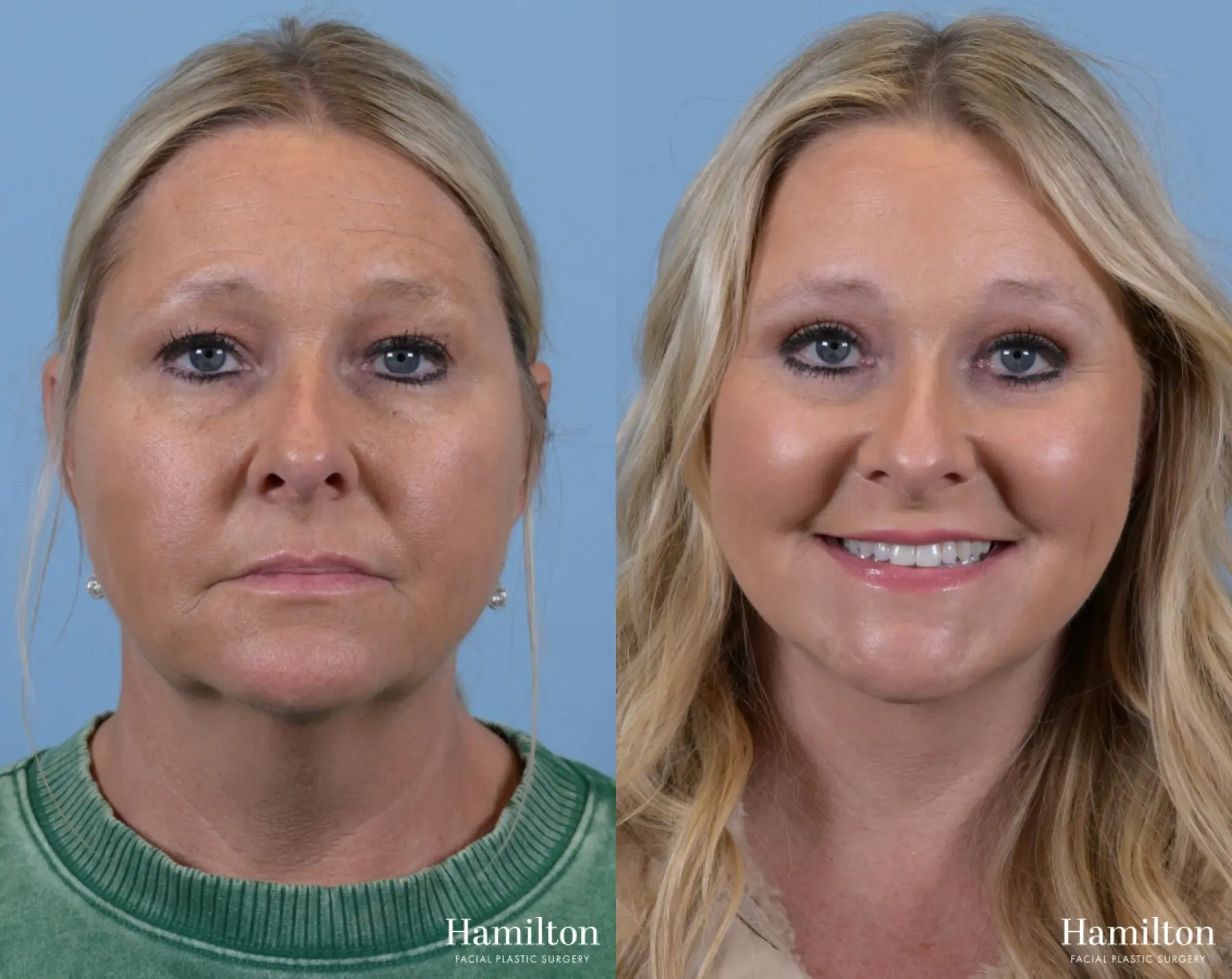 Brow Lift: Patient 6 - Before and After 4
