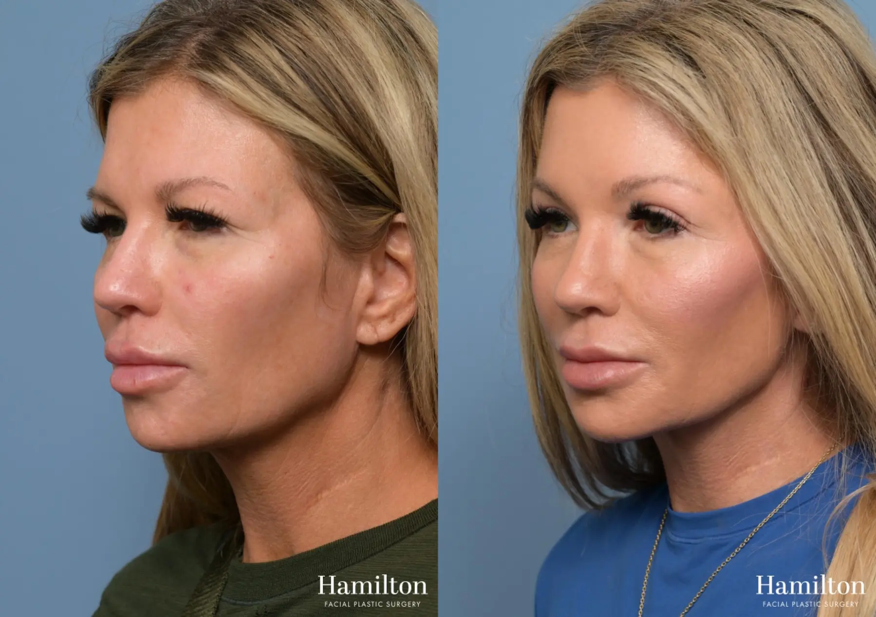 Brow Lift: Patient 2 - Before and After 2