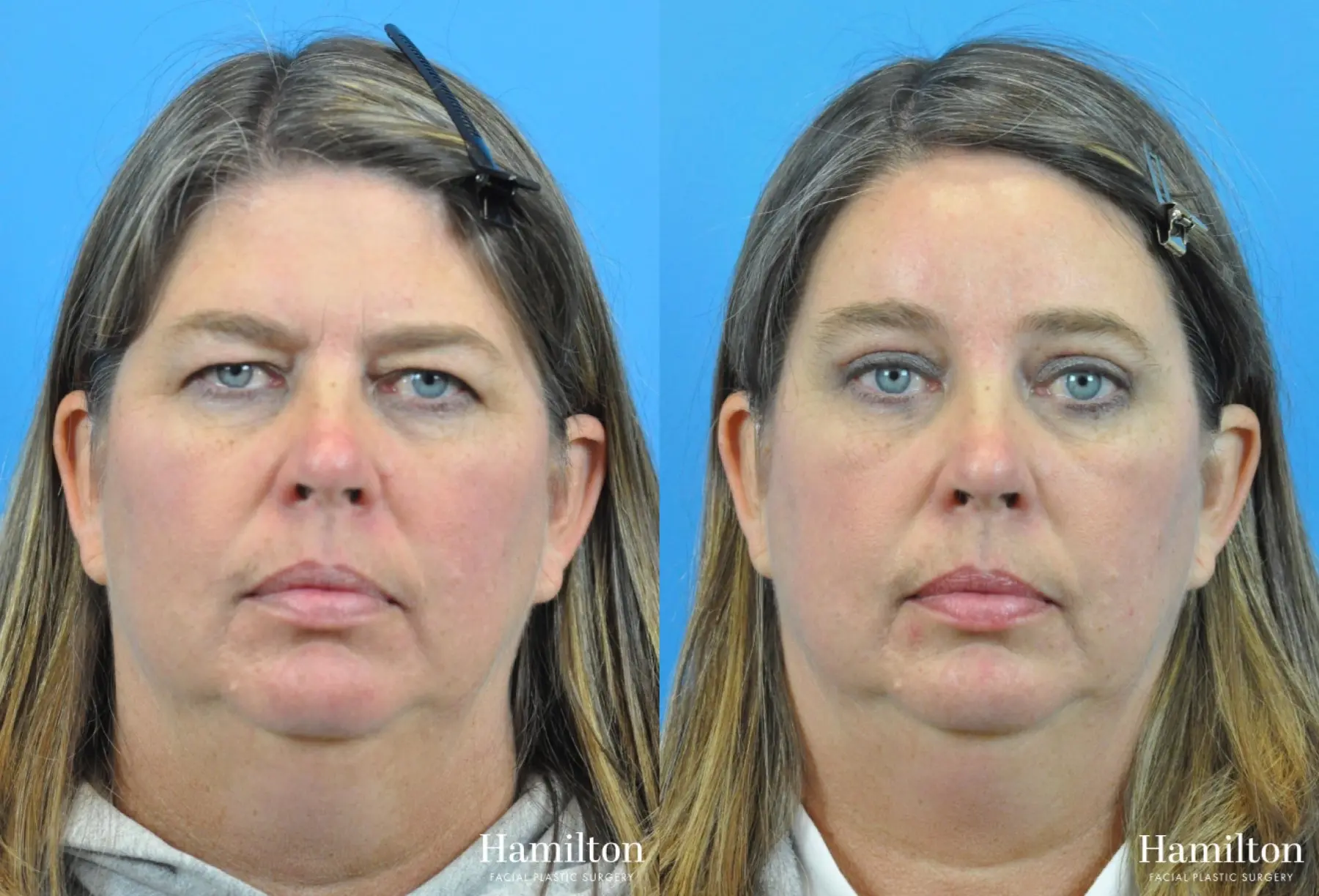 Brow Lift: Patient 8 - Before and After  