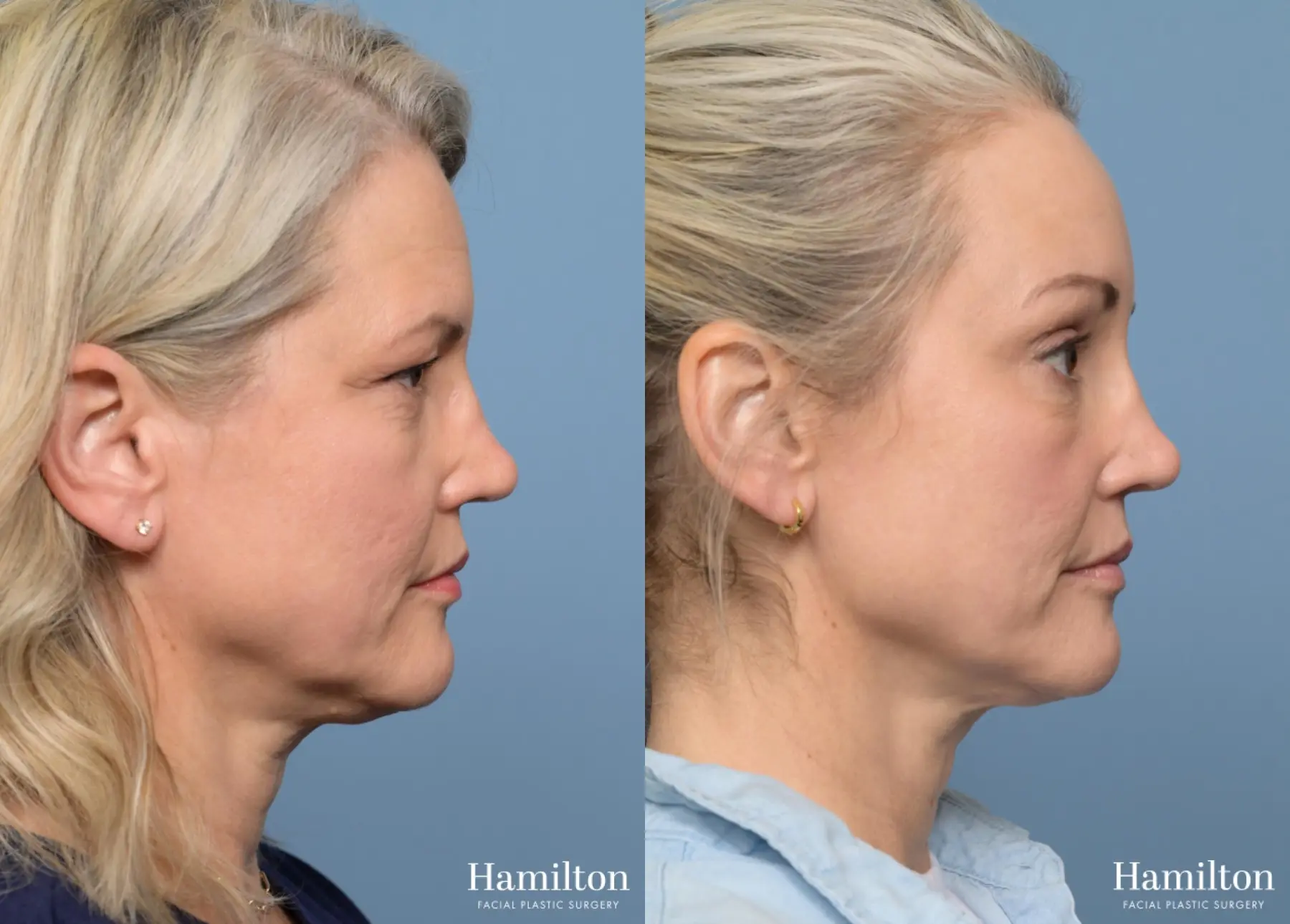 Brow Lift: Patient 3 - Before and After 5