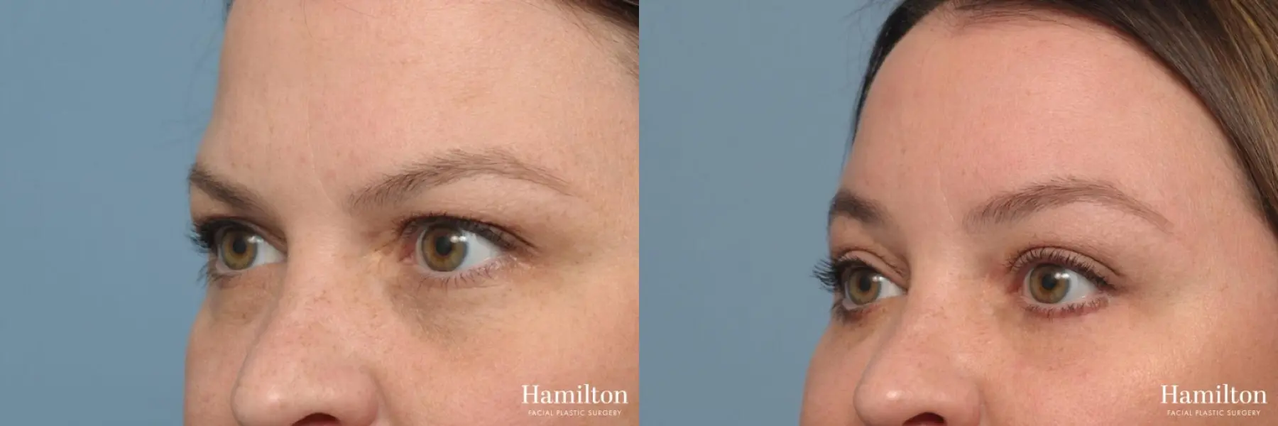 Brow Lift: Patient 1 - Before and After 2
