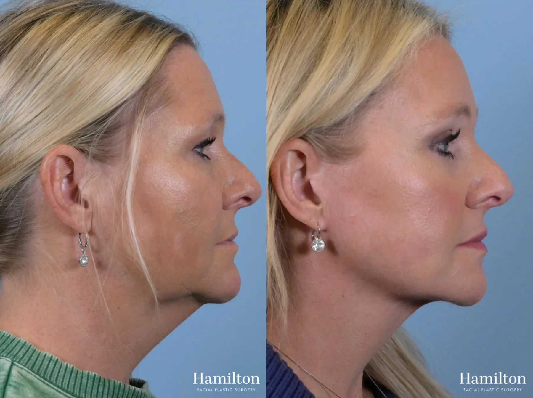 Brow Lift: Patient 6 - Before and After 3