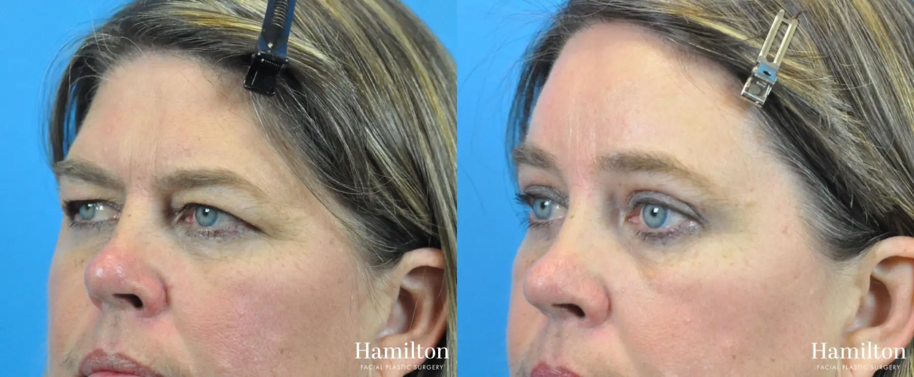 Brow Lift: Patient 8 - Before and After 2