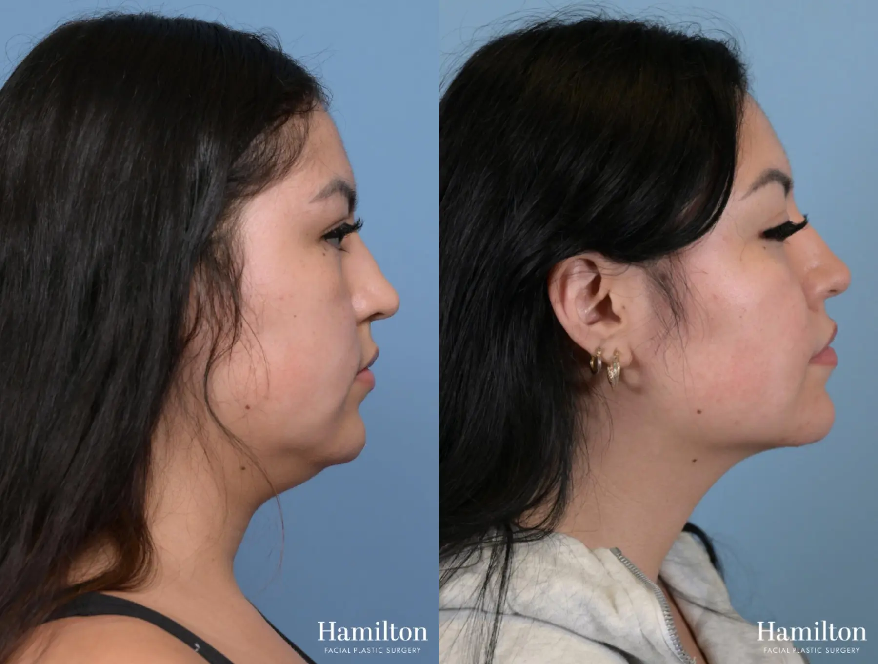 Buccal Fat Removal: Patient 1 - Before and After 3
