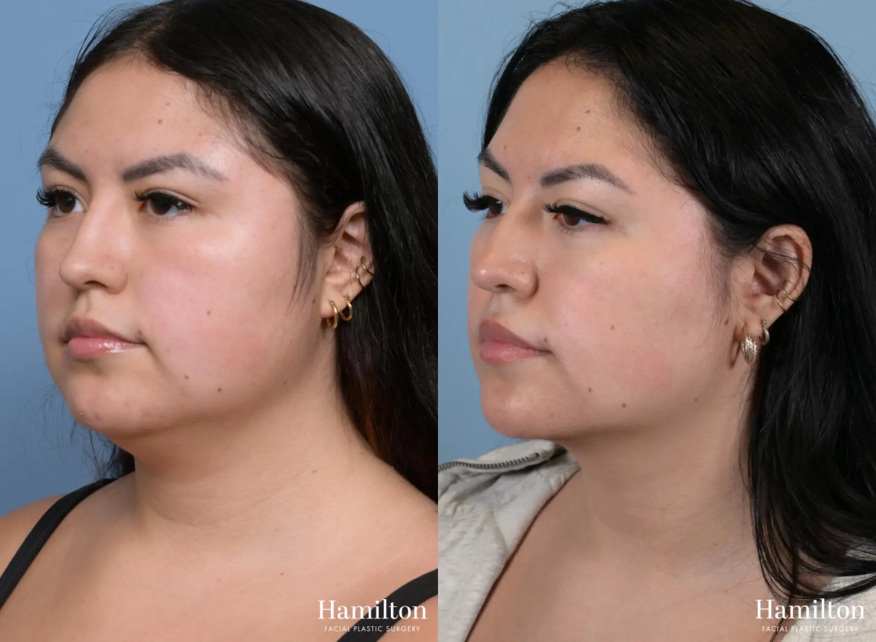 Buccal Fat Removal: Patient 1 - Before and After 5