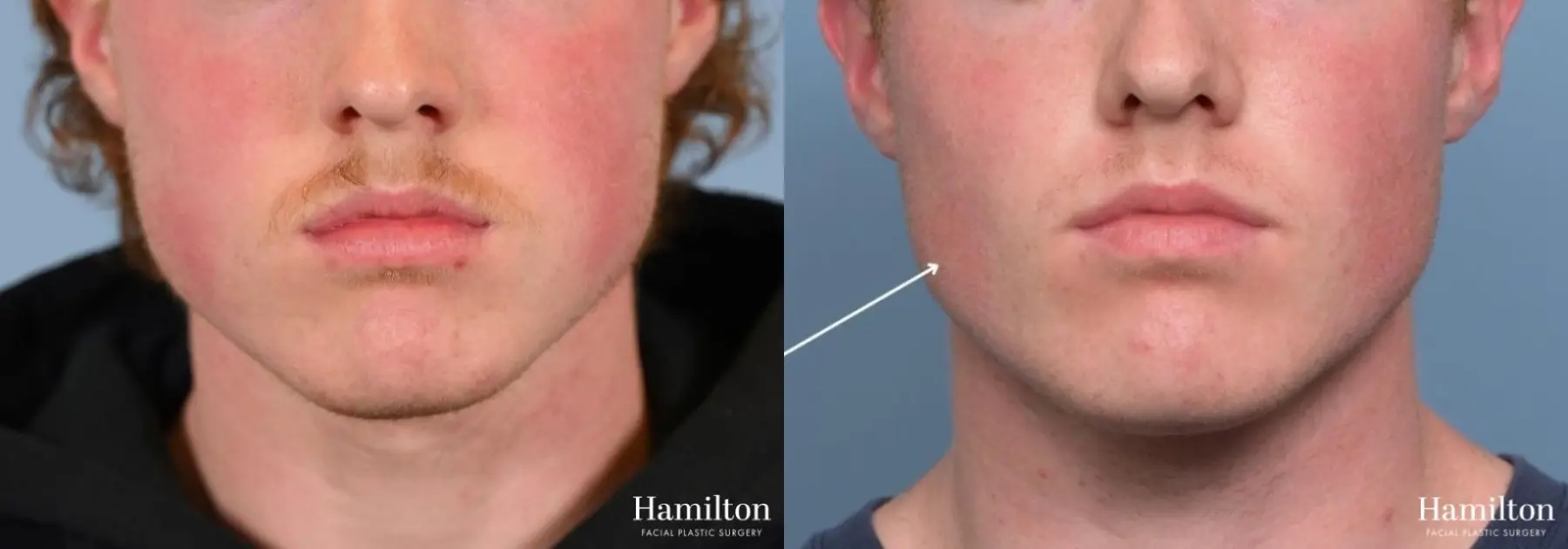 Buccal Fat Removal: Patient 2 - Before and After  