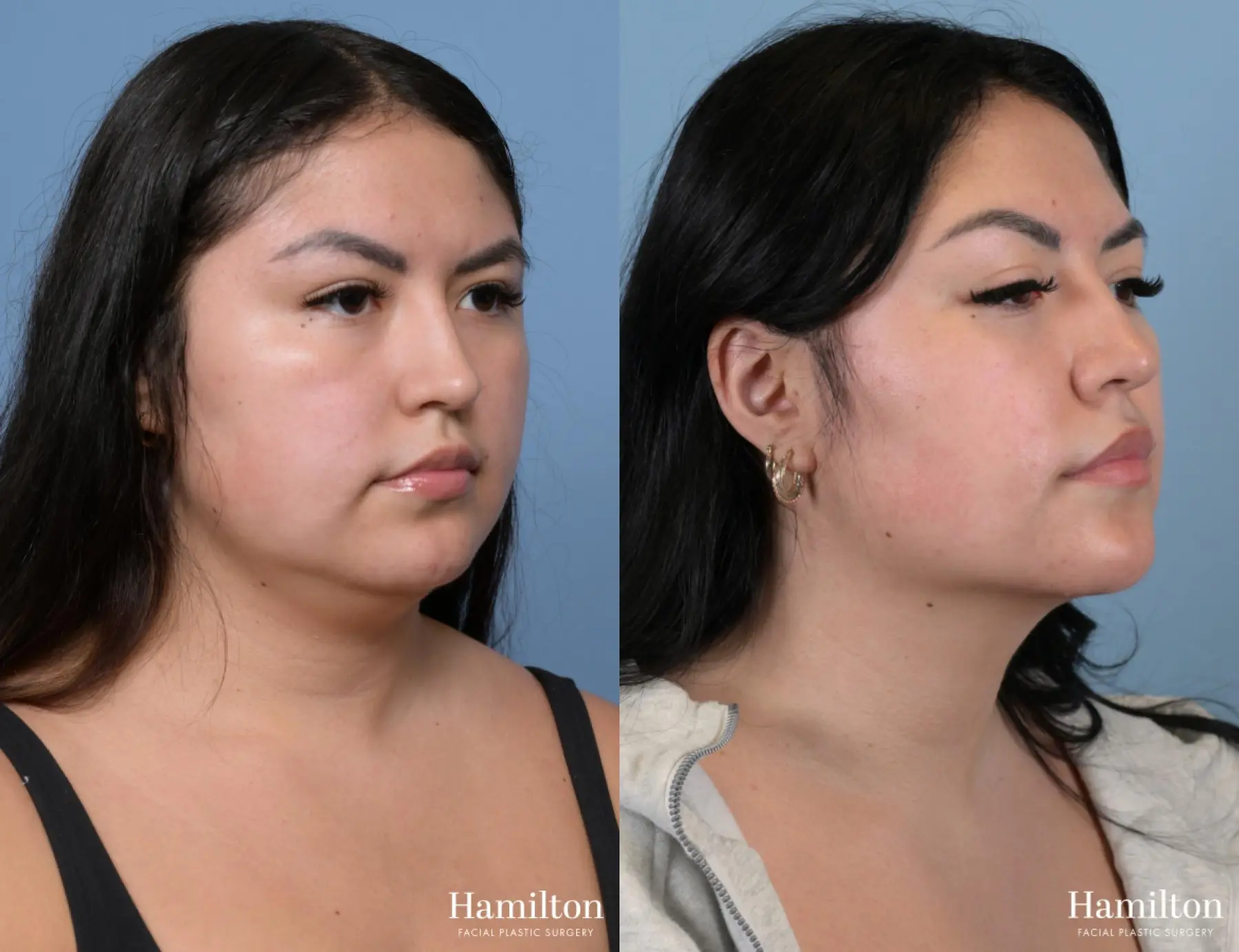 Buccal Fat Removal: Patient 1 - Before and After 2