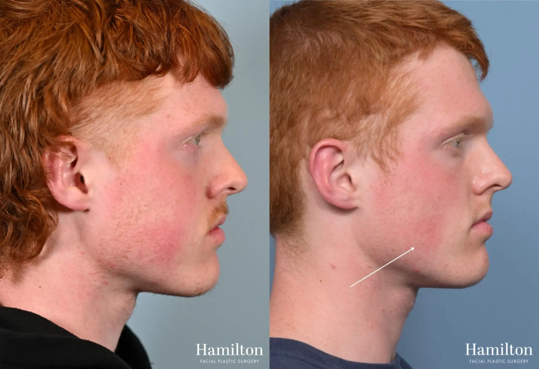 Buccal Fat Removal: Patient 2 - Before and After 2