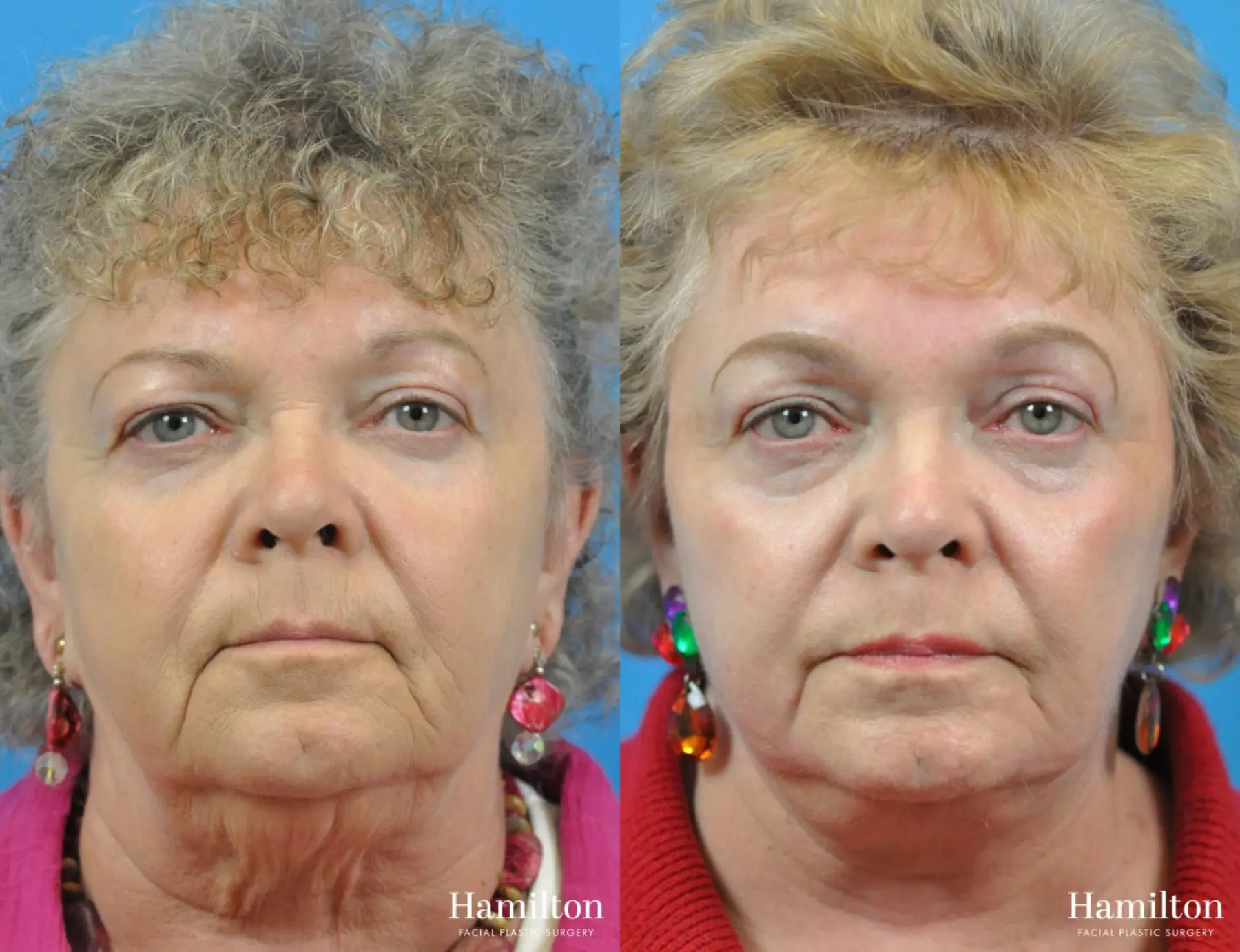 C02 Laser: Patient 9 - Before and After 1