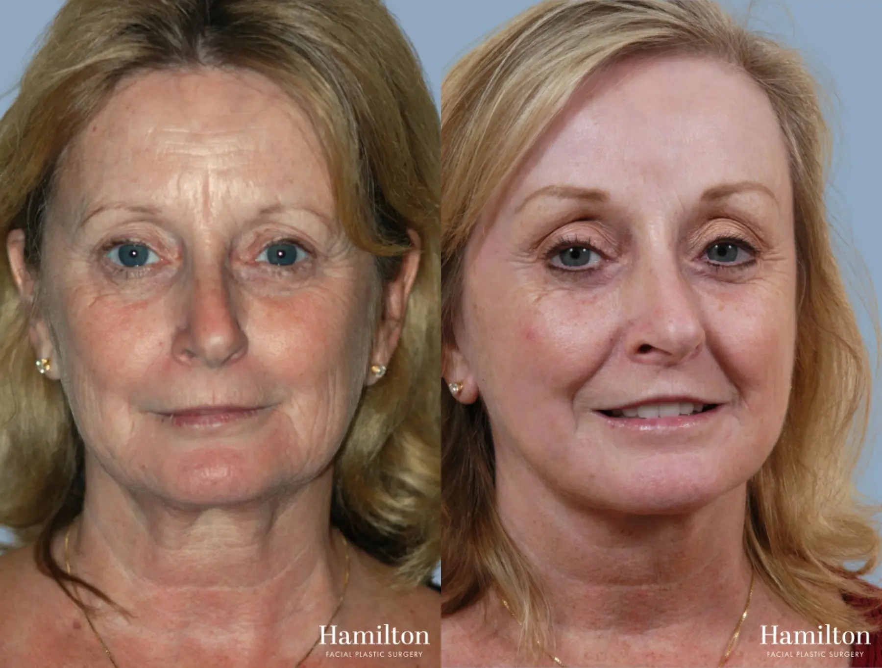 C02 Laser: Patient 3 - Before and After 1