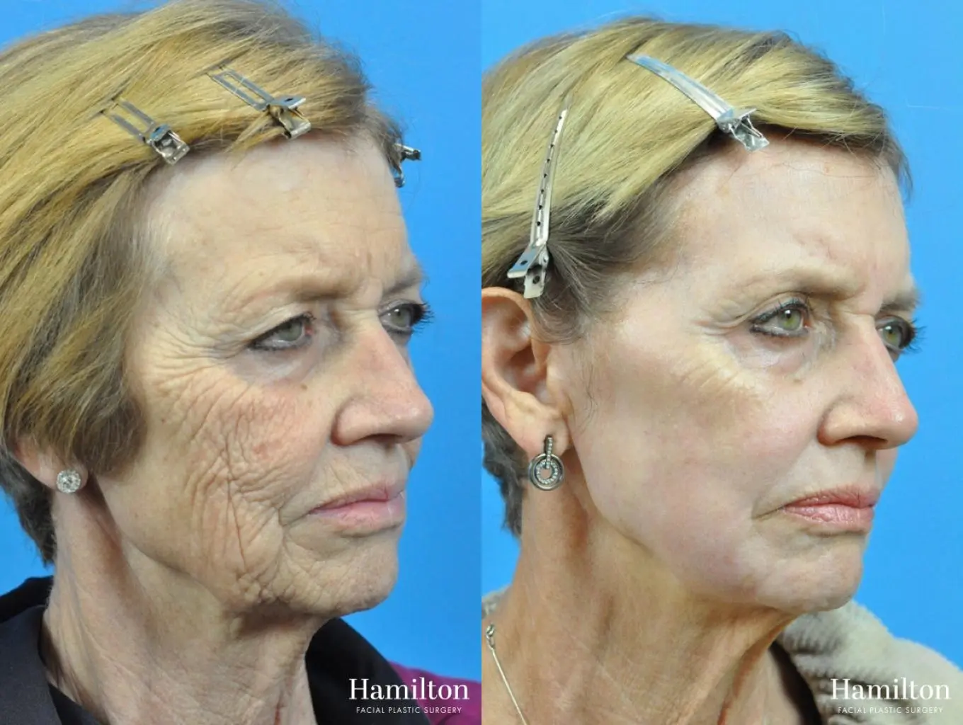 C02 Laser: Patient 4 - Before and After 3