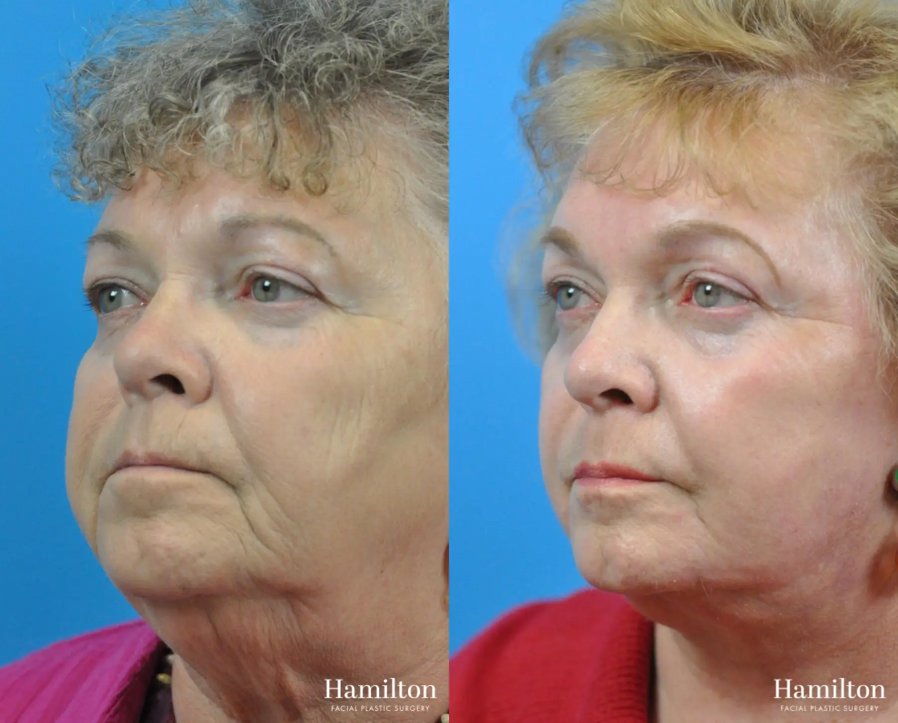 C02 Laser: Patient 9 - Before and After 3