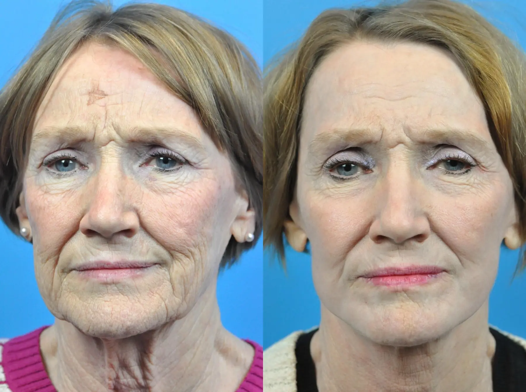 C02 Laser: Patient 11 - Before and After 3