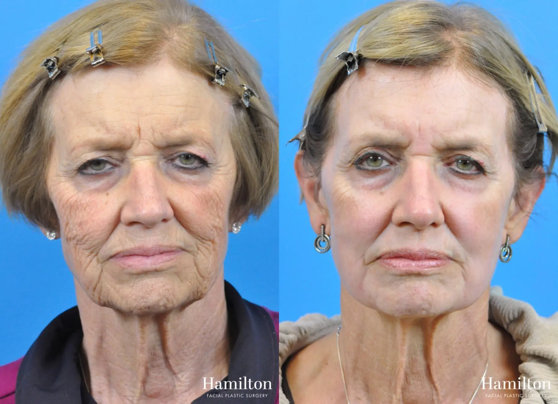 C02 Laser: Patient 6 - Before and After 3