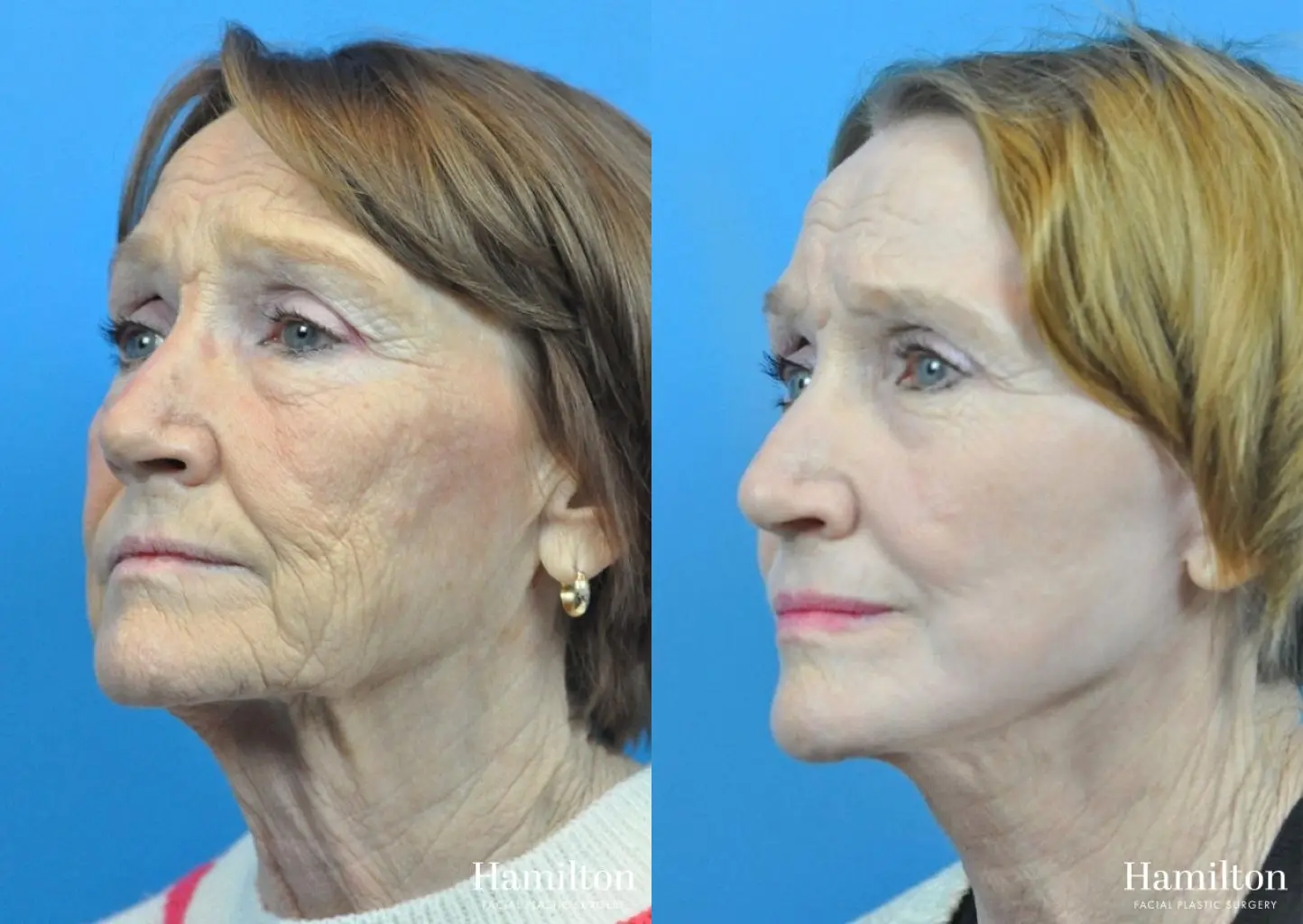 C02 Laser: Patient 5 - Before and After  
