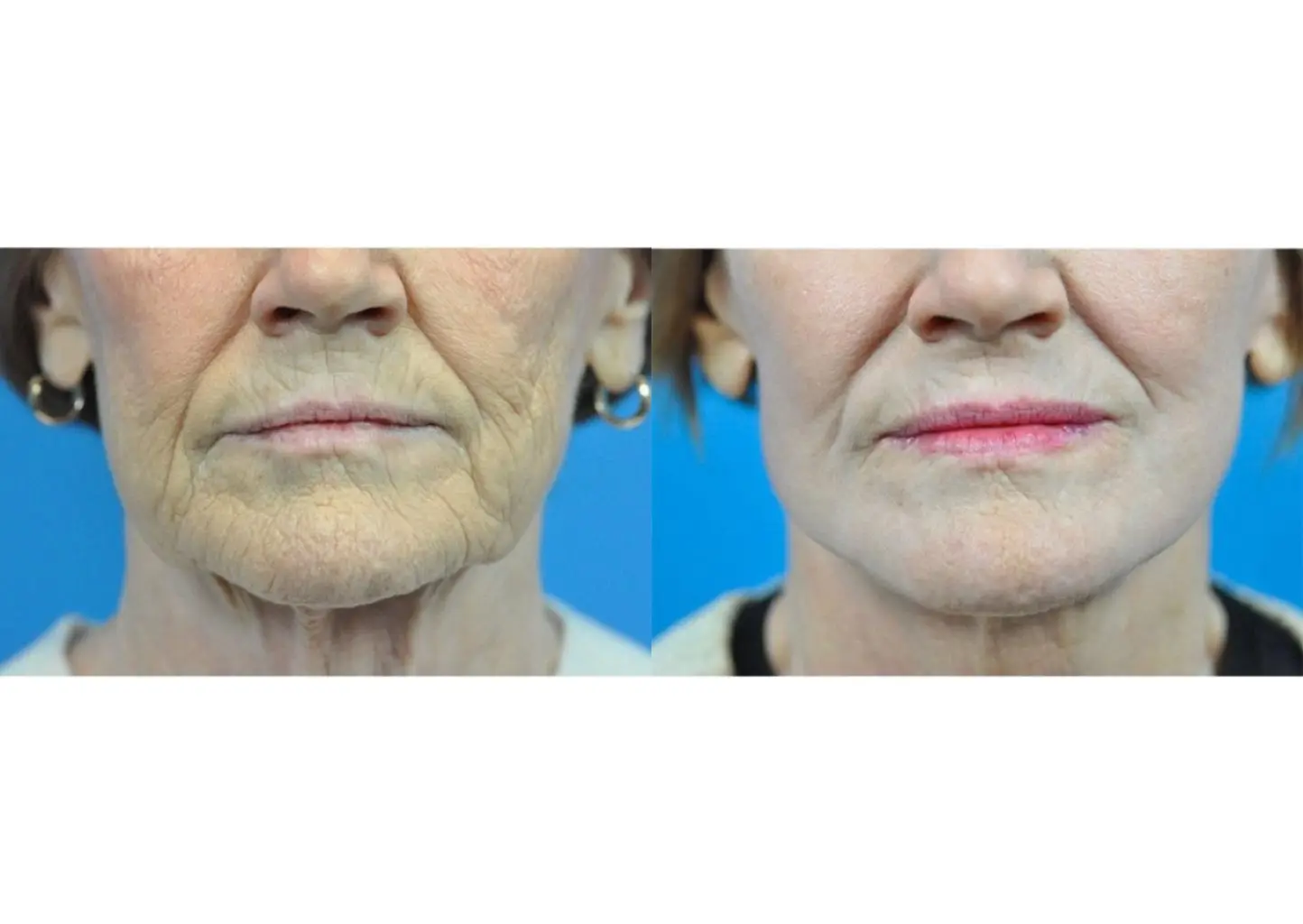 C02 Laser: Patient 5 - Before and After 3