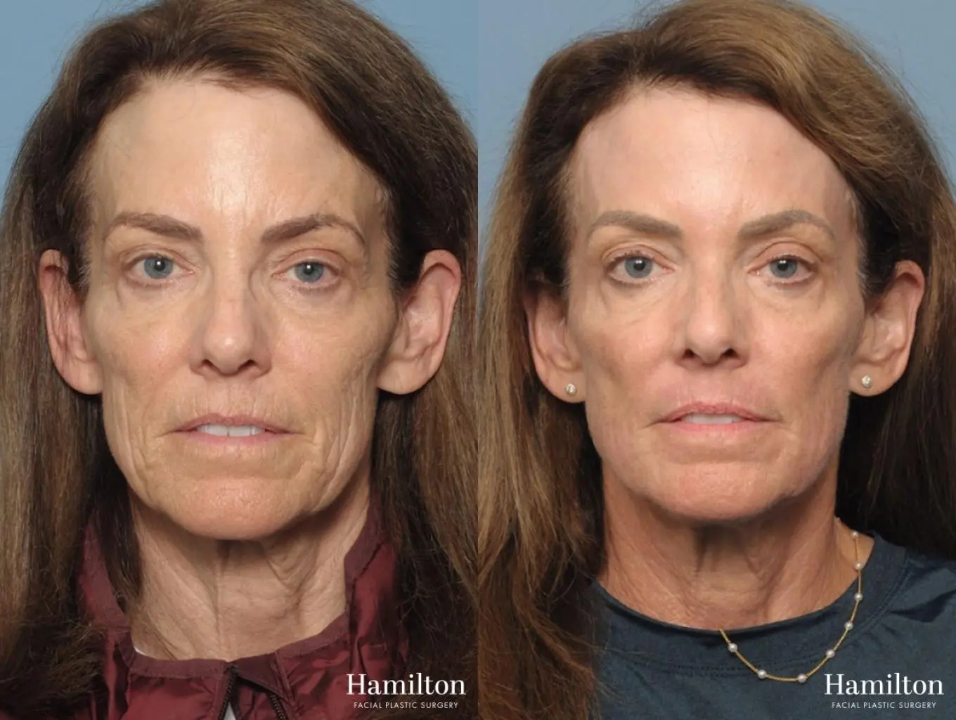 C02 Laser: Patient 3 - Before and After  