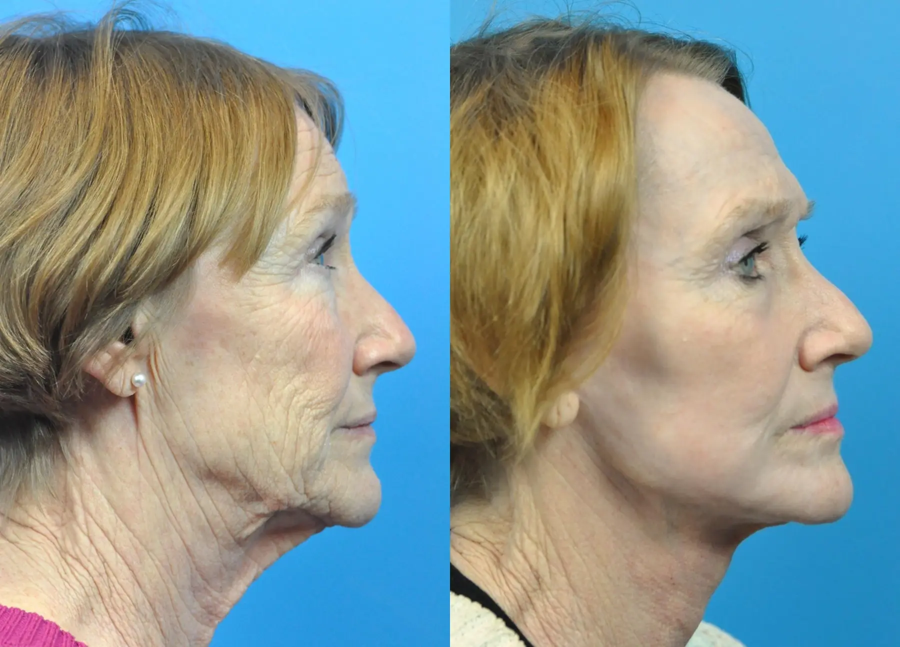 C02 Laser: Patient 11 - Before and After 2