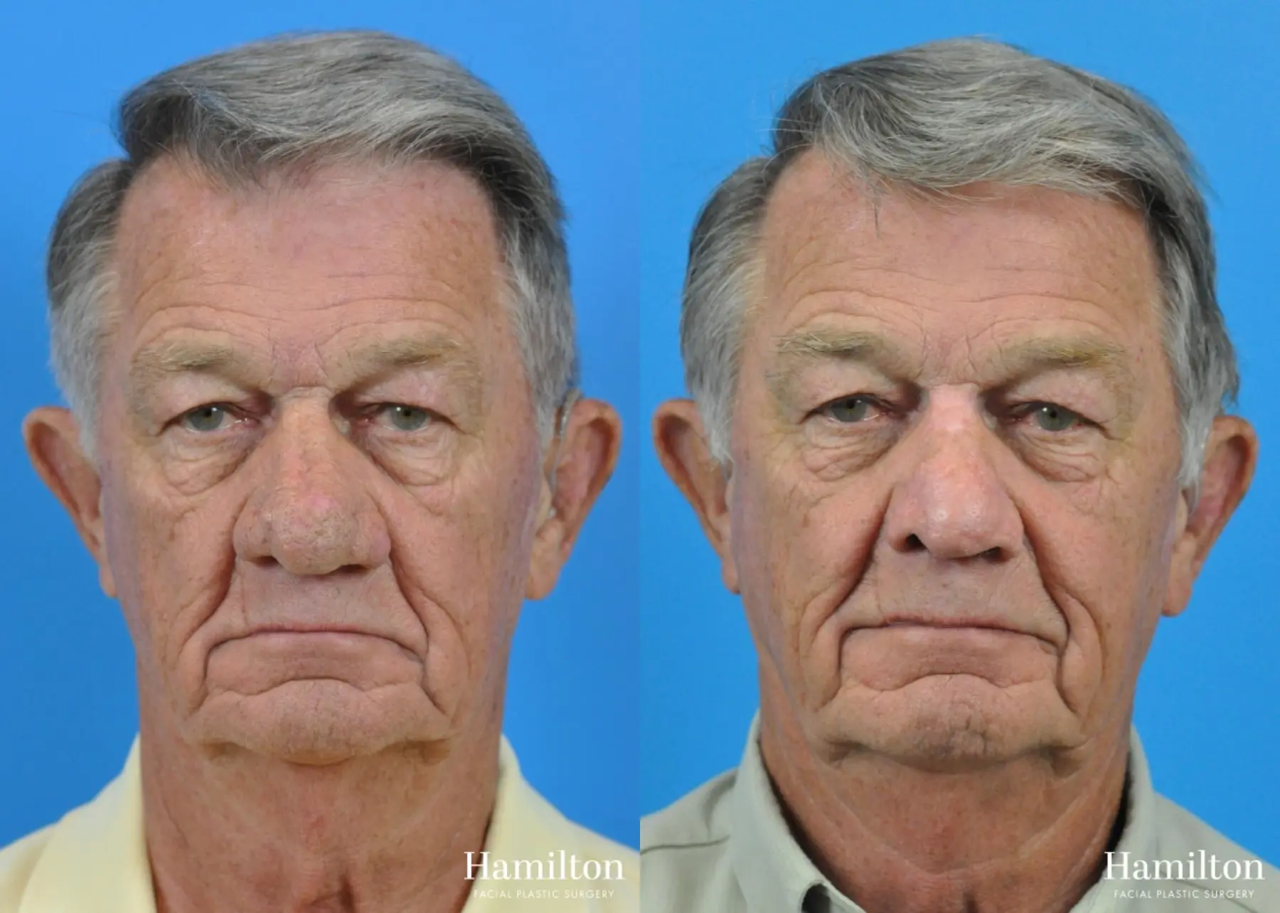 C02 Laser: Patient 7 - Before and After 3