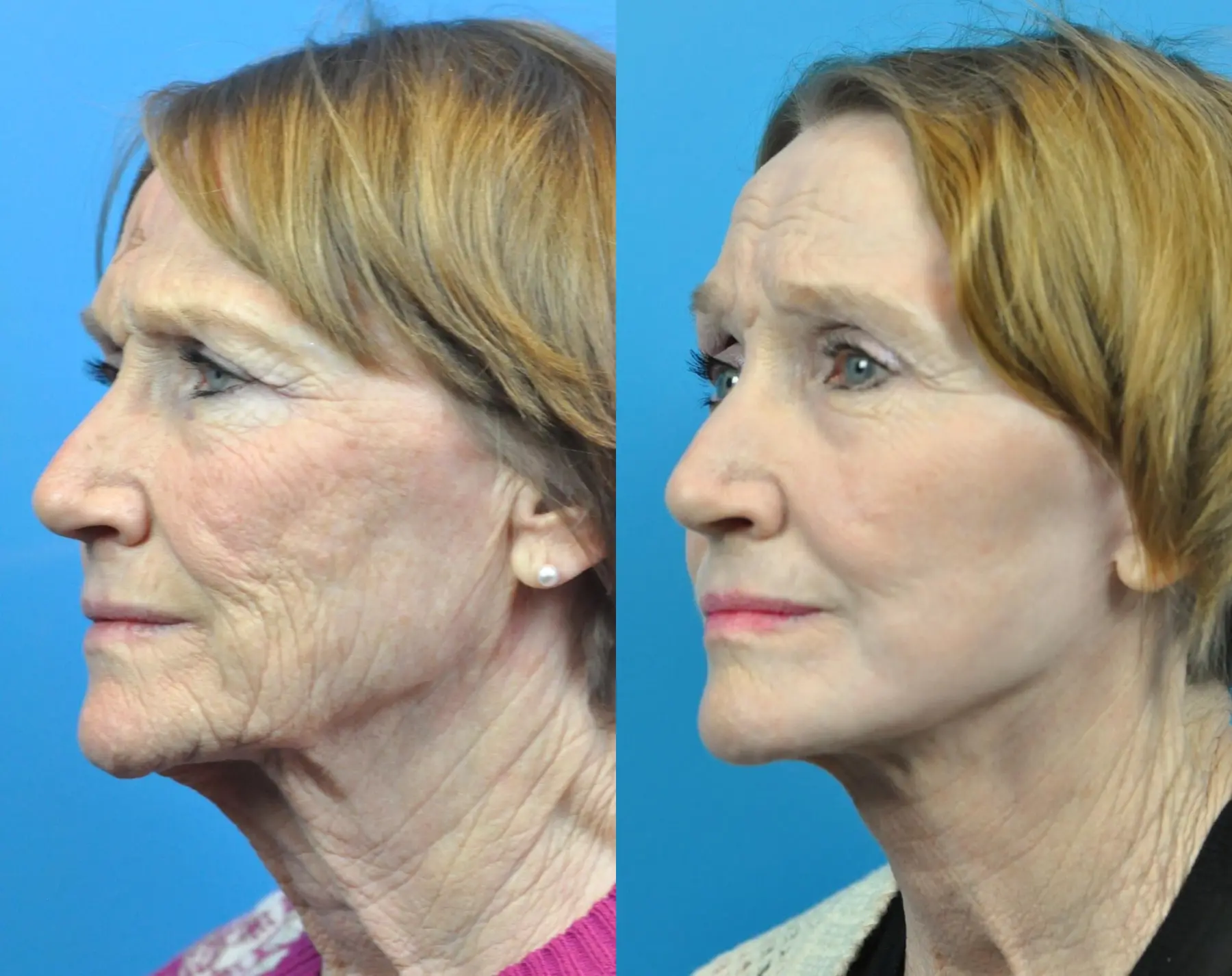 C02 Laser: Patient 11 - Before and After 4