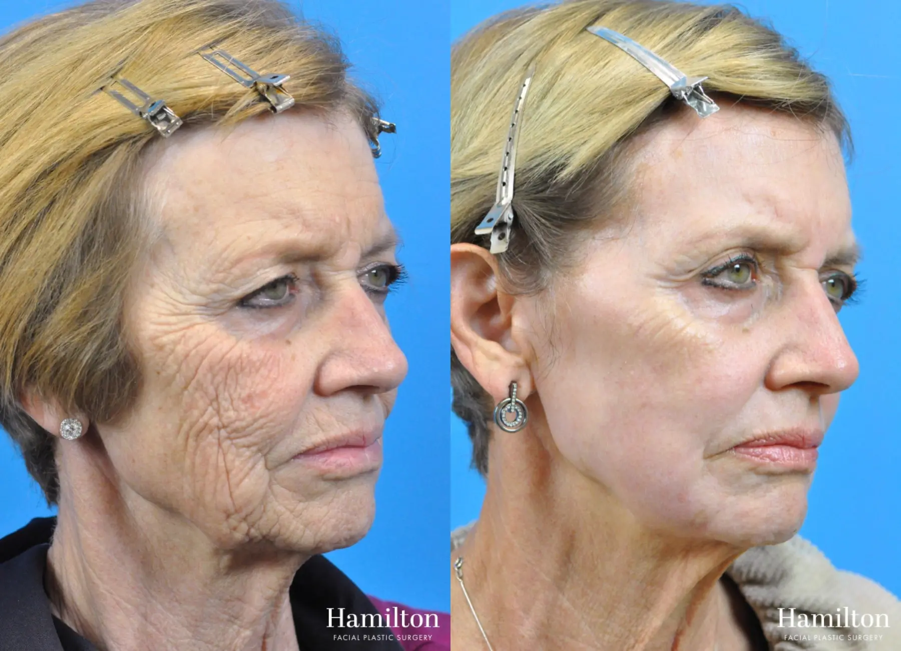 C02 Laser: Patient 6 - Before and After 1