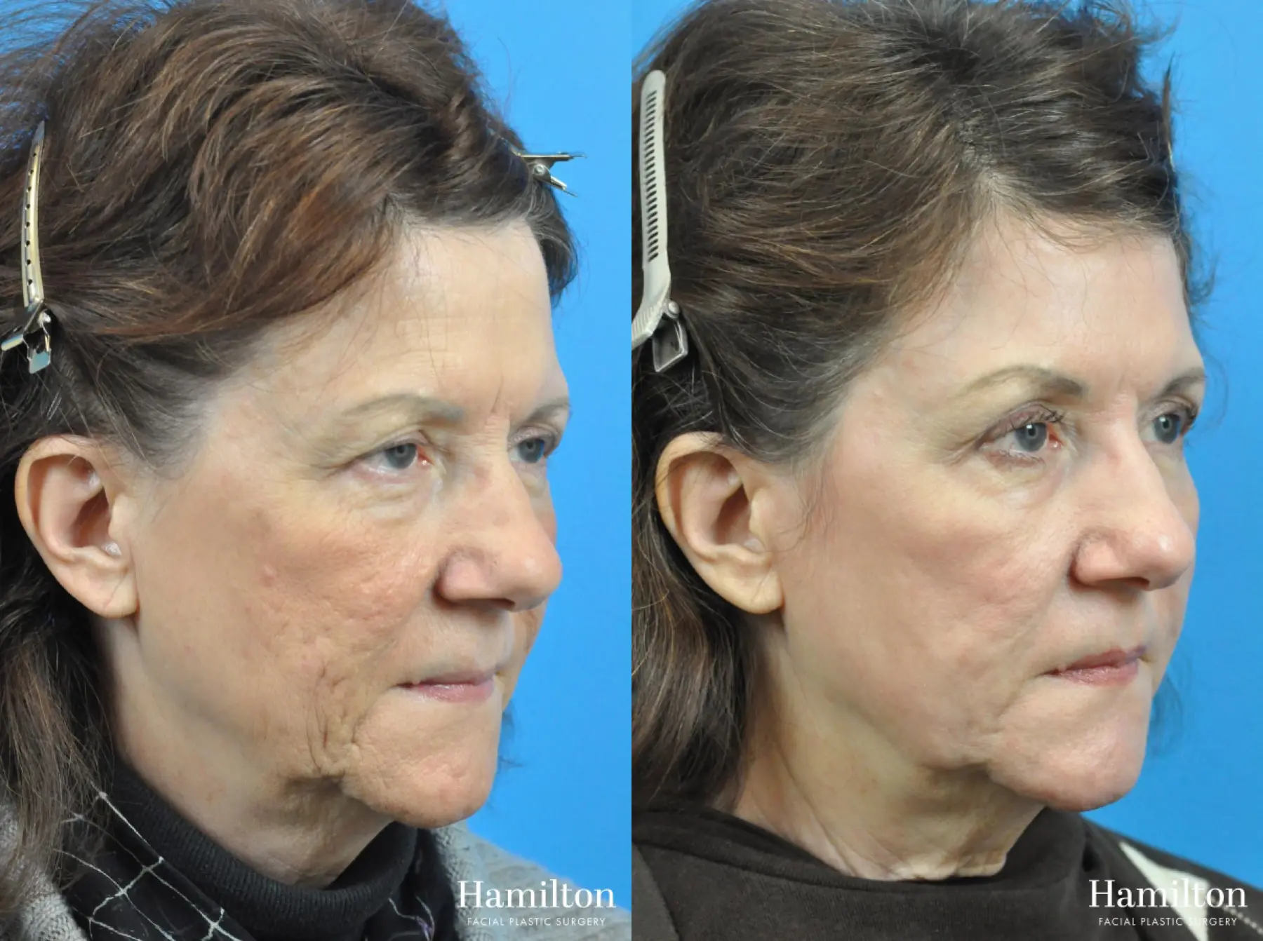 C02 Laser: Patient 12 - Before and After 1