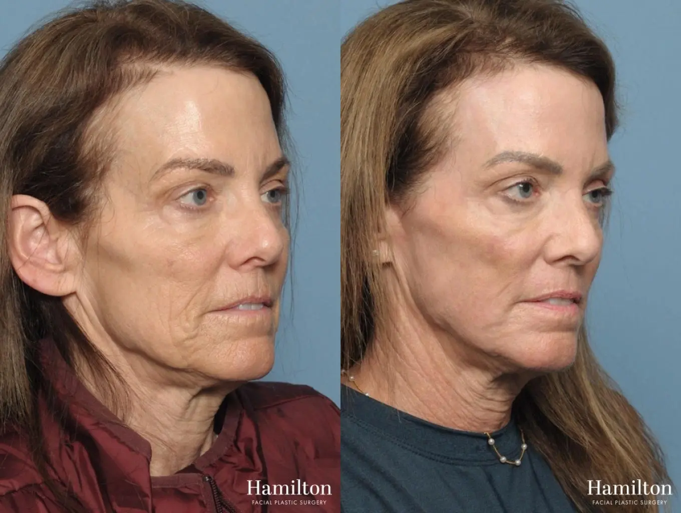 C02 Laser: Patient 3 - Before and After 4