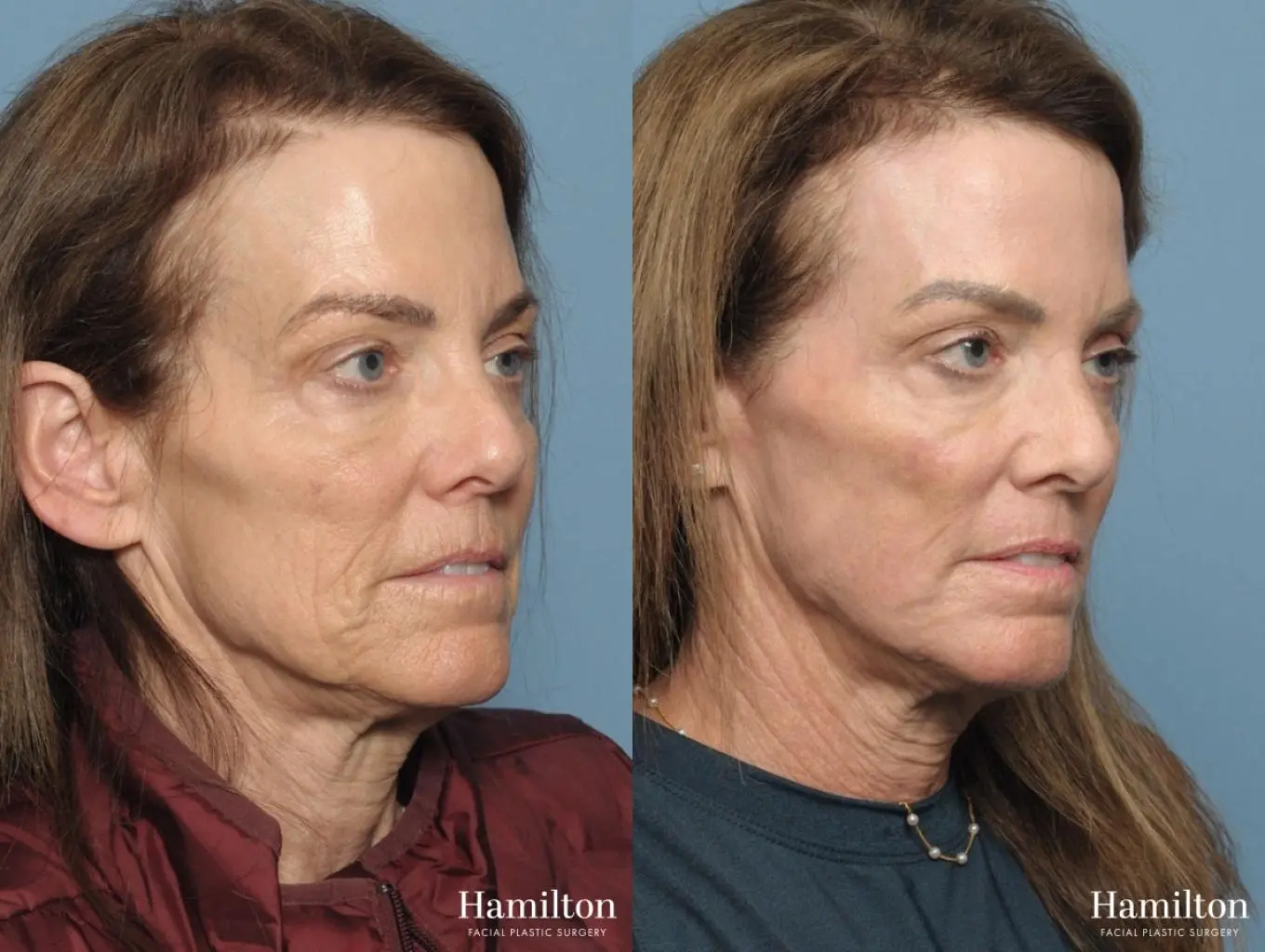 C02 Laser: Patient 4 - Before and After 4