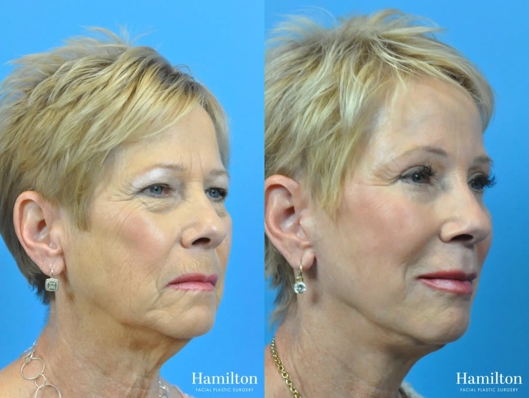C02 Laser: Patient 2 - Before and After 2