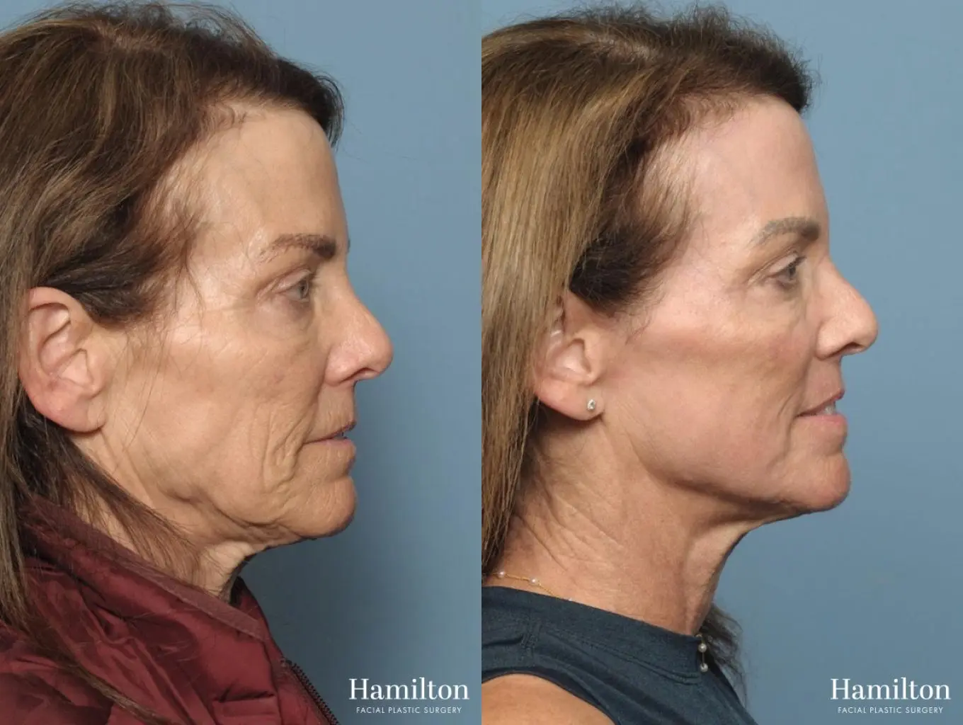 C02 Laser: Patient 3 - Before and After 5