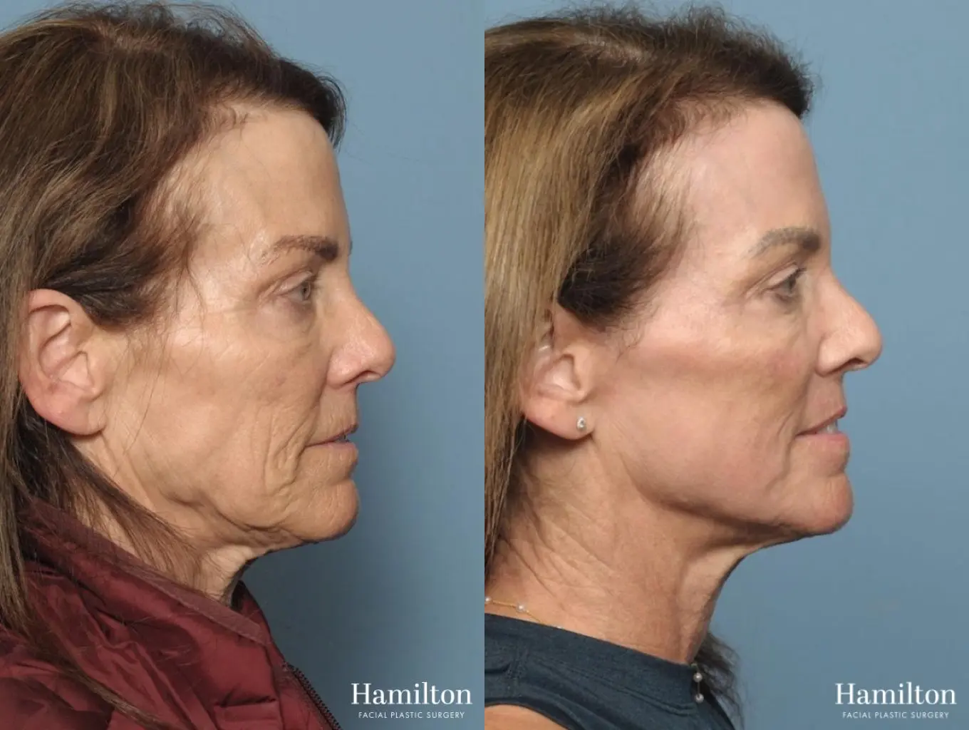 C02 Laser: Patient 4 - Before and After 5
