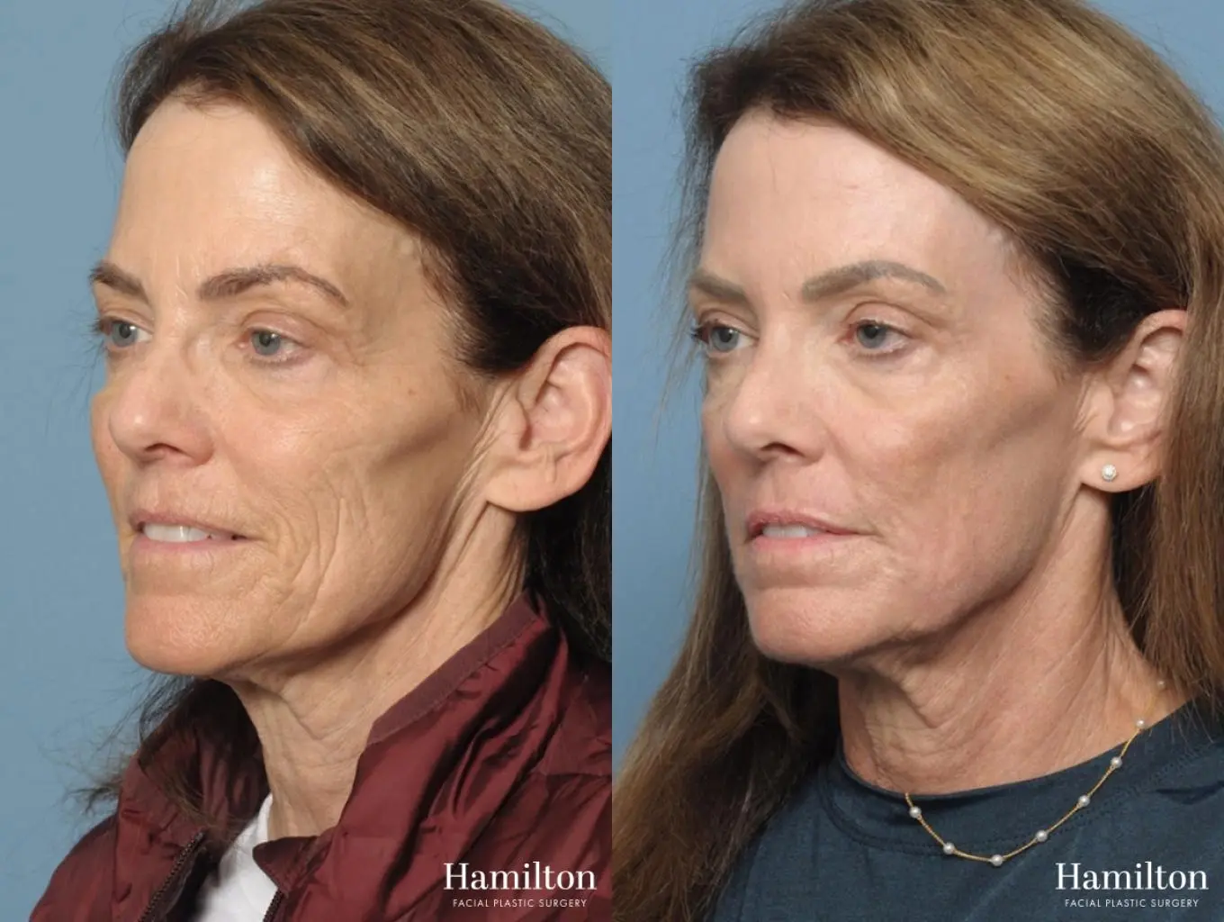 C02 Laser: Patient 4 - Before and After 2