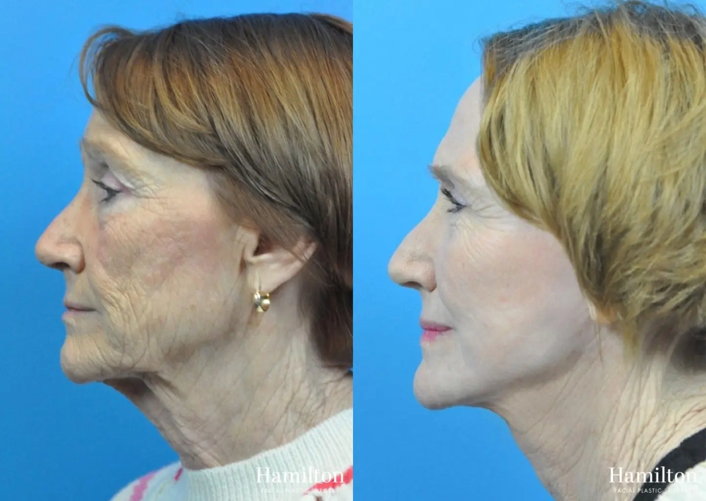 C02 Laser: Patient 5 - Before and After 2