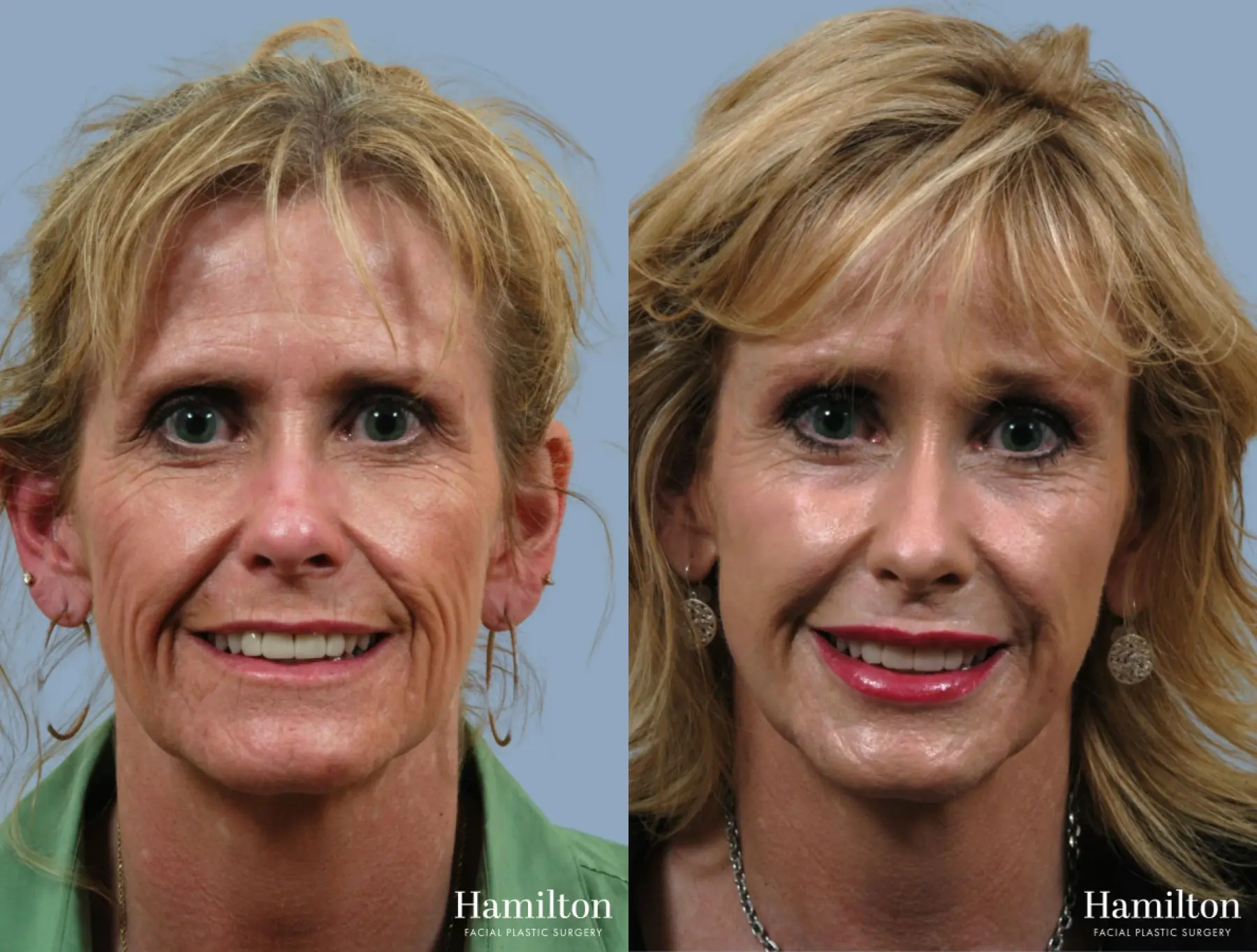 C02 Laser: Patient 5 - Before and After