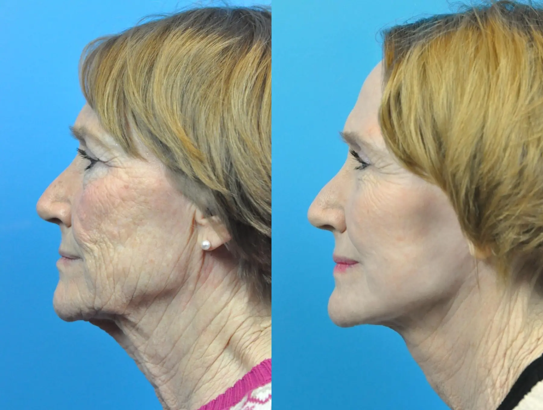 C02 Laser: Patient 11 - Before and After 1