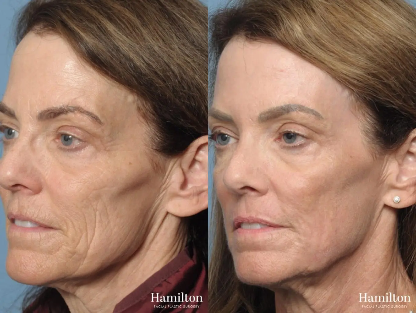 C02 Laser: Patient 3 - Before and After 3