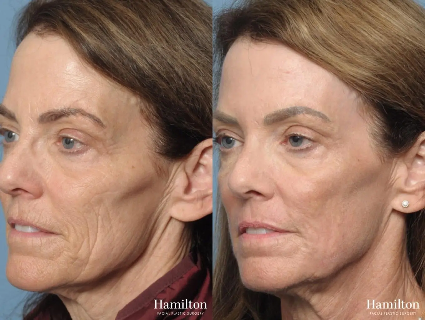 C02 Laser: Patient 4 - Before and After 3