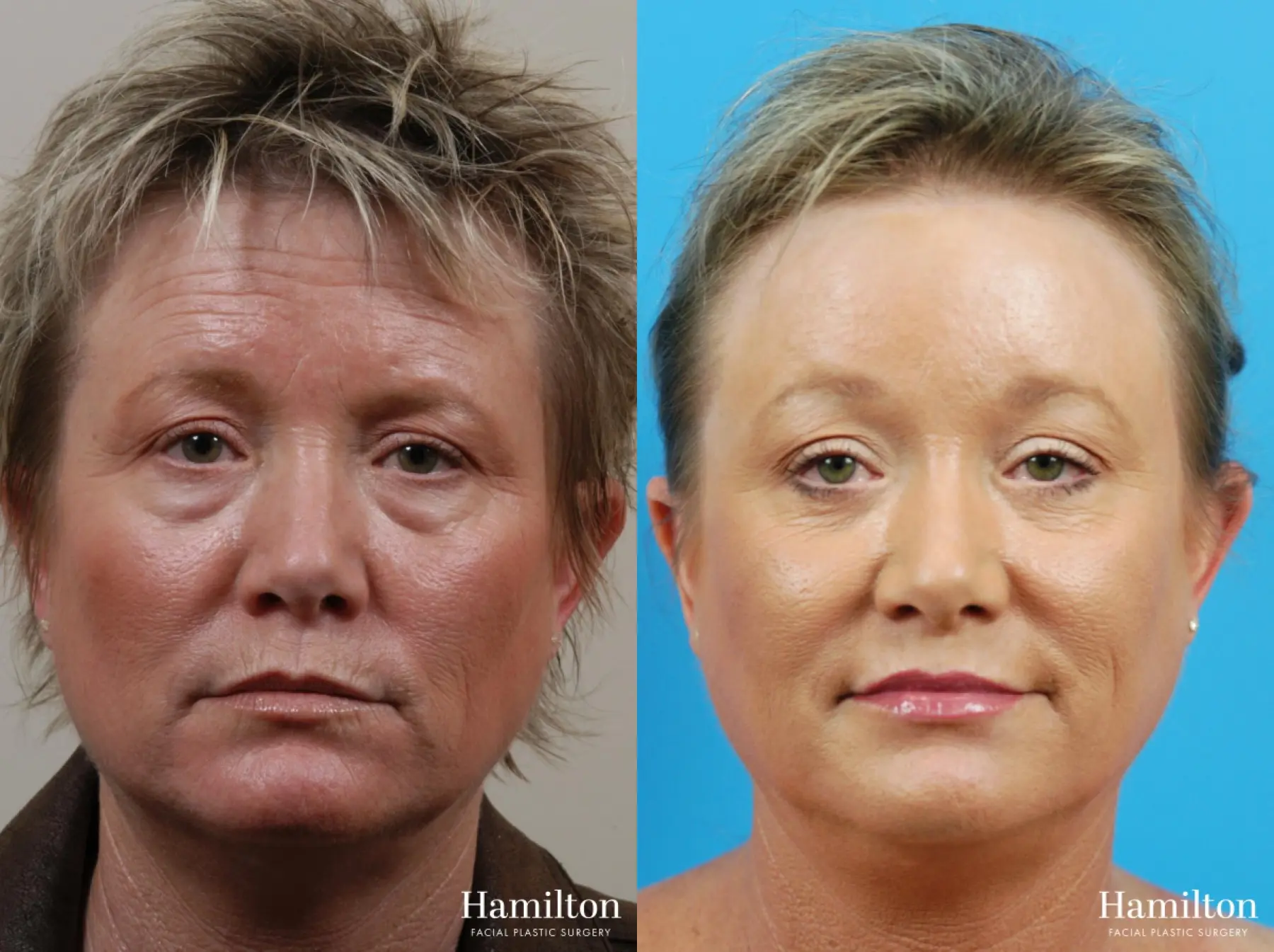 C02 Laser: Patient 2 - Before and After  