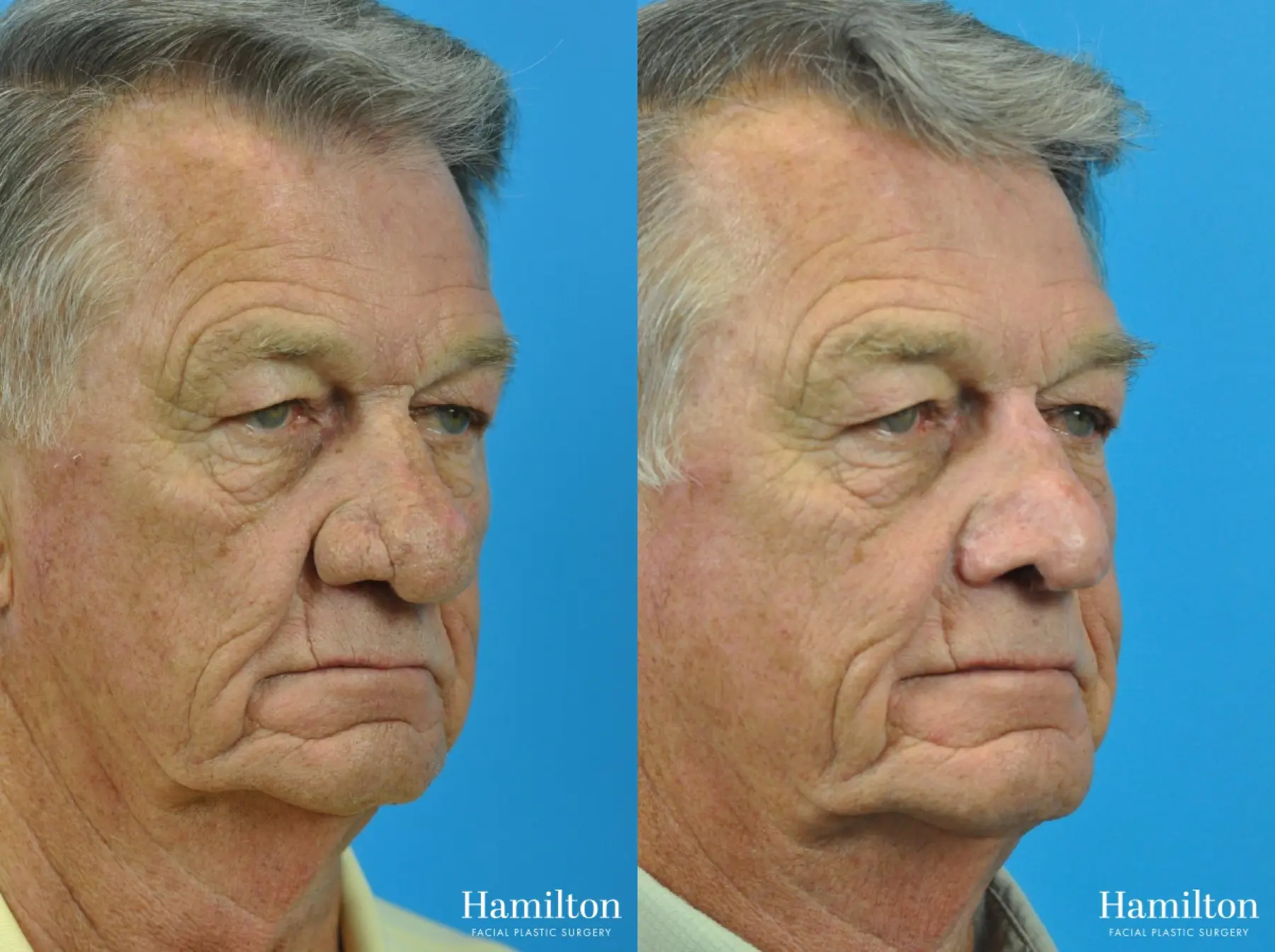 C02 Laser: Patient 7 - Before and After 1